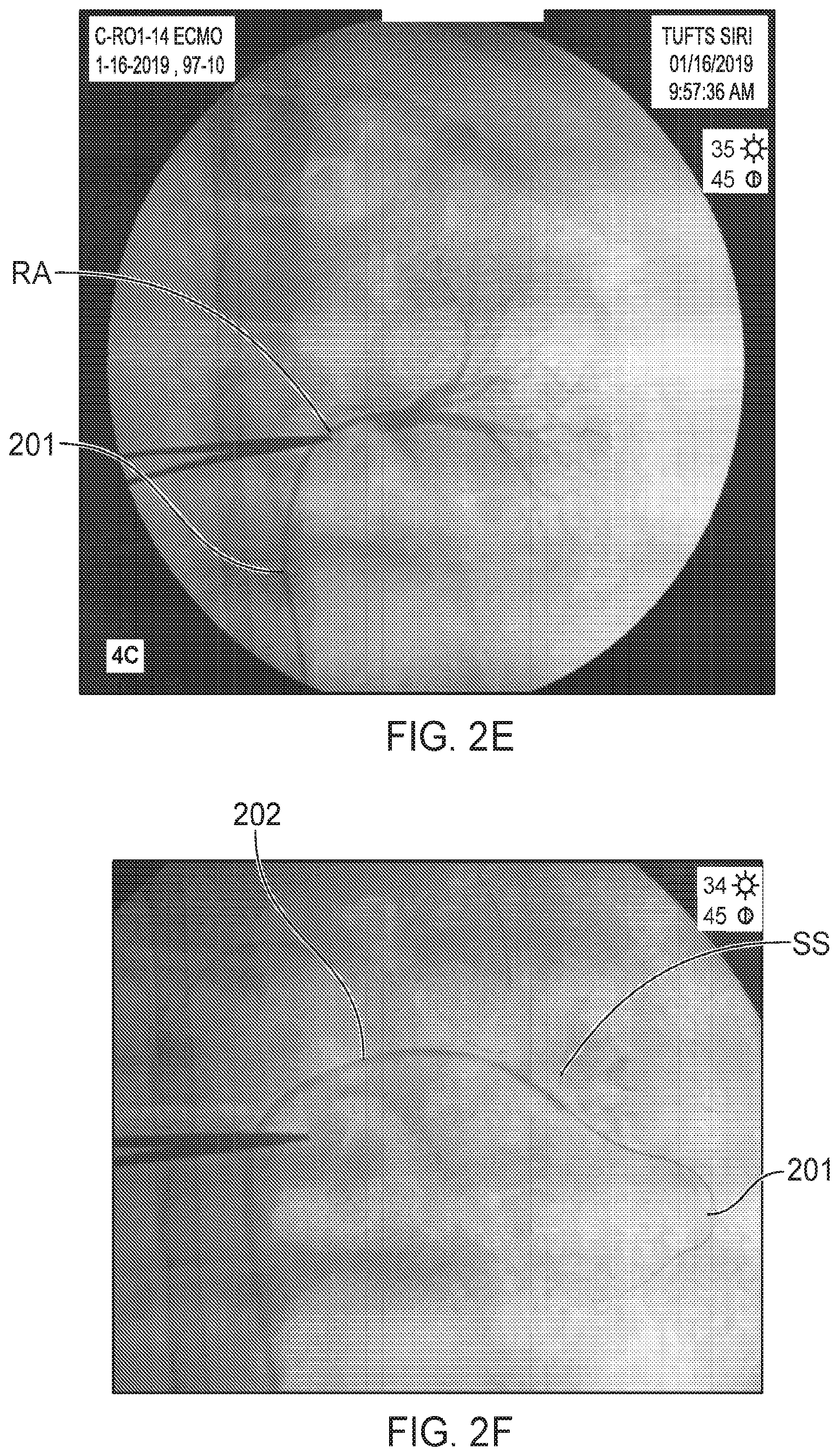 Patent US12564423 Figure 3 – Systems and methods for accessing a renal capsule for diagnostic and therapeutic purposes