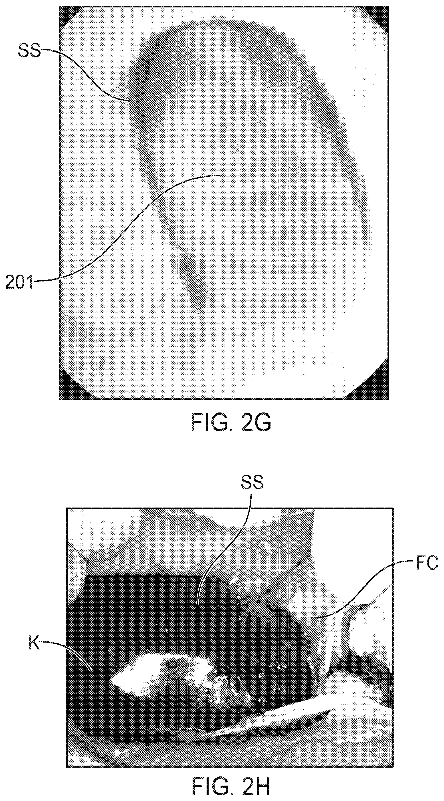 Patent US12564423 Figure 4 – Systems and methods for accessing a renal capsule for diagnostic and therapeutic purposes