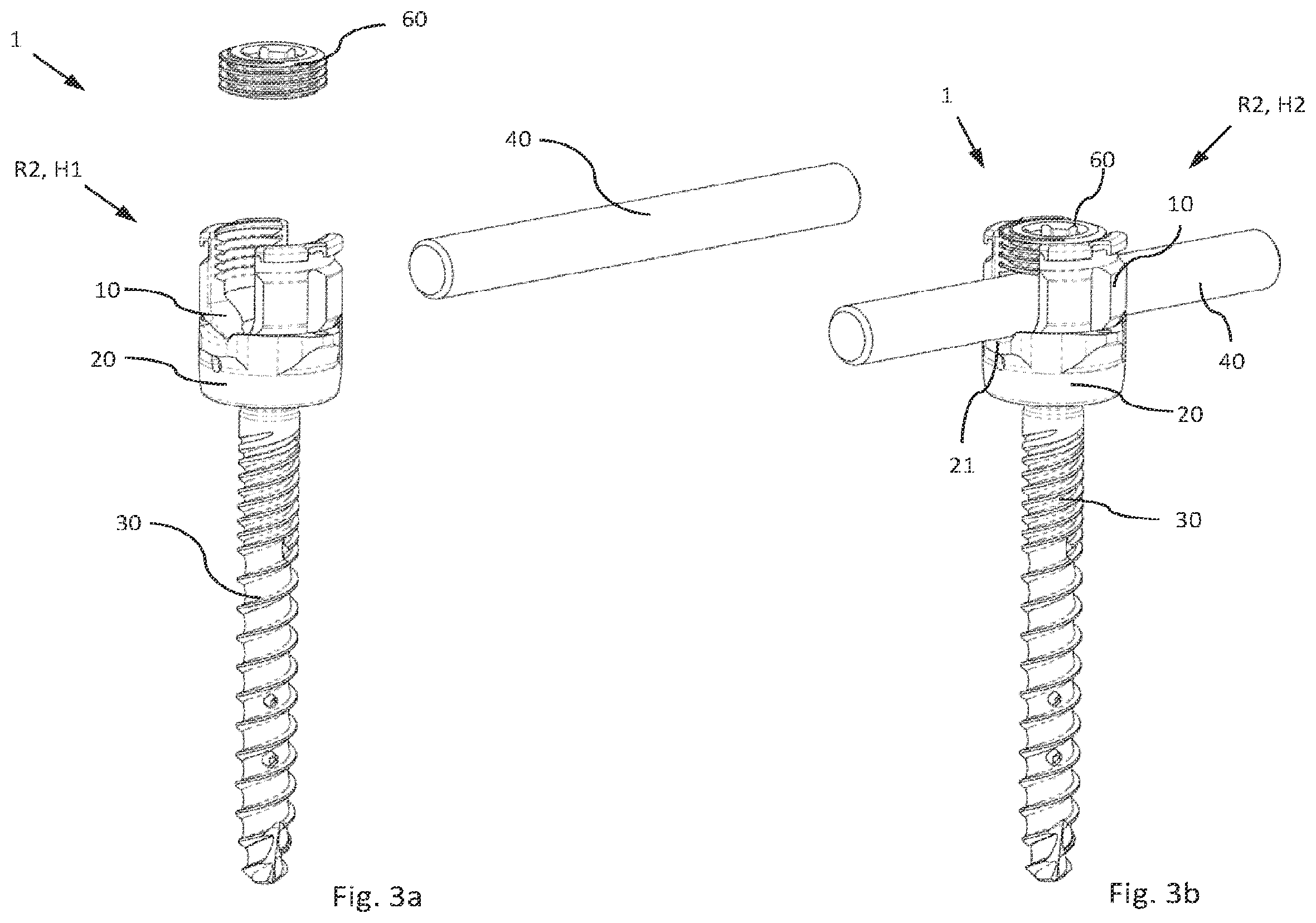 Patent US12564426 Figure 3 – Modular and temporarily fixable osteosynthesis device for vertebrae