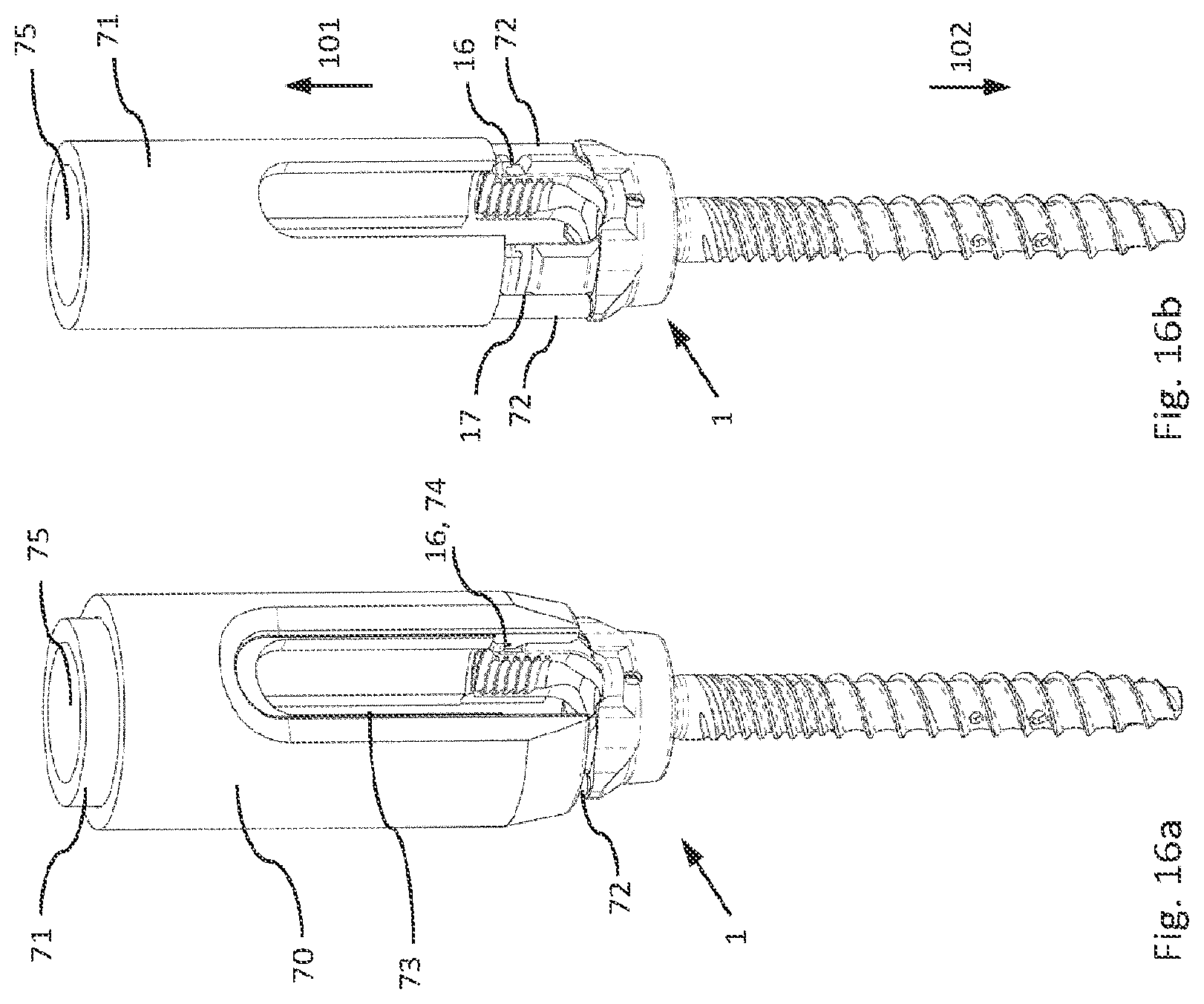 Patent US12564426 Figure 15 – Modular and temporarily fixable osteosynthesis device for vertebrae