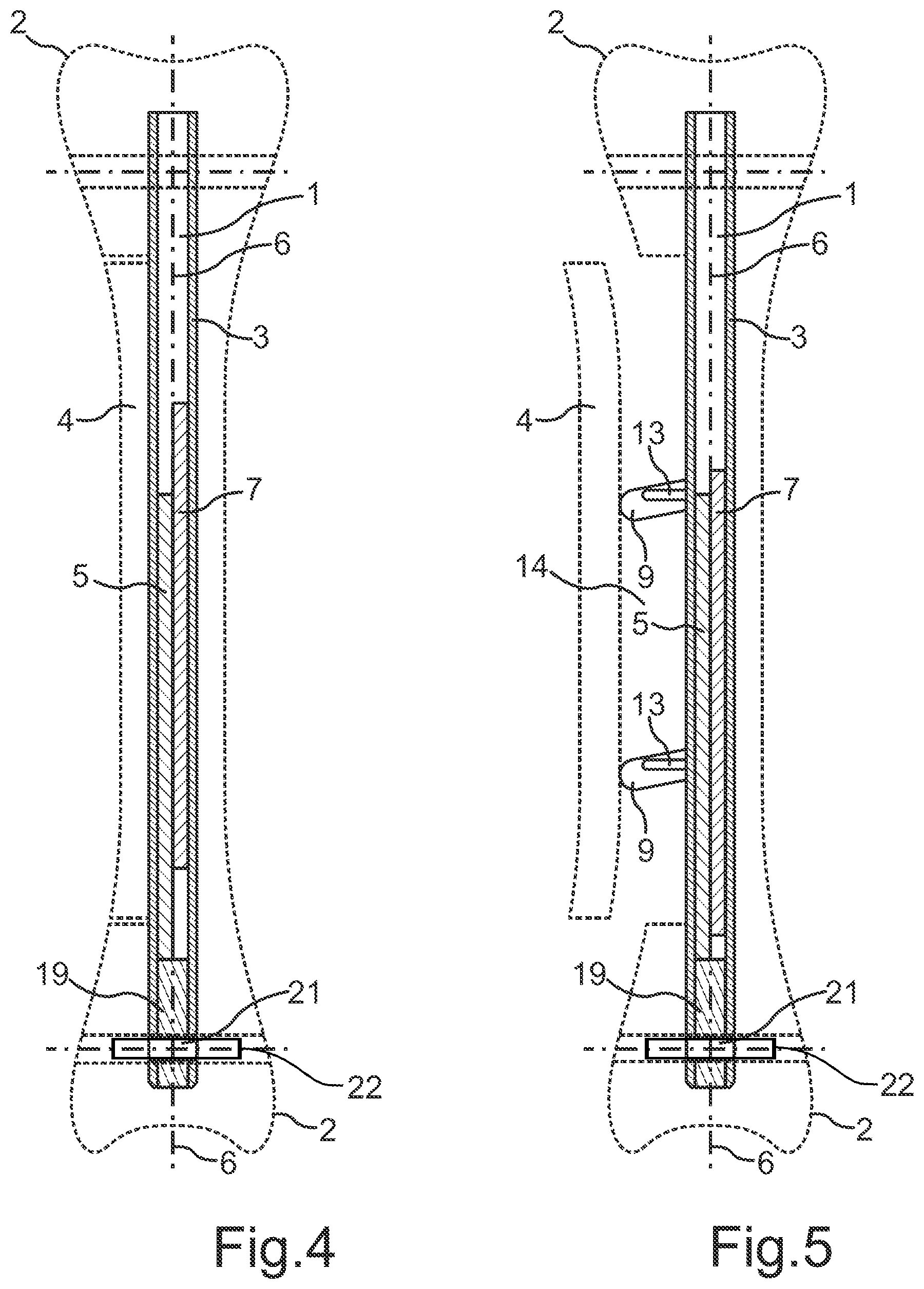 Patent US12564428 Figure 3 – Intramedullary nail for transverse distraction