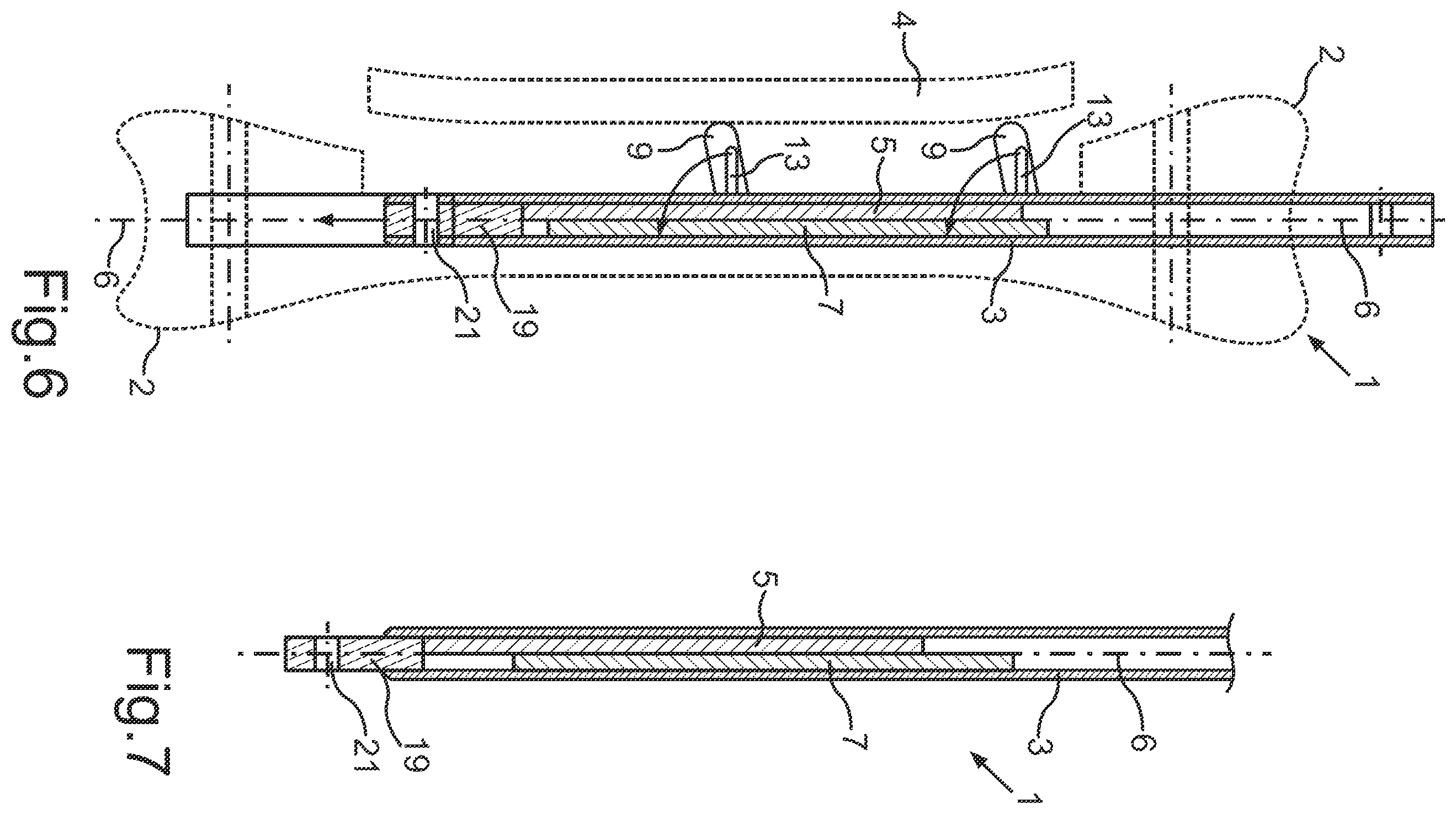Patent US12564428 Figure 4 – Intramedullary nail for transverse distraction