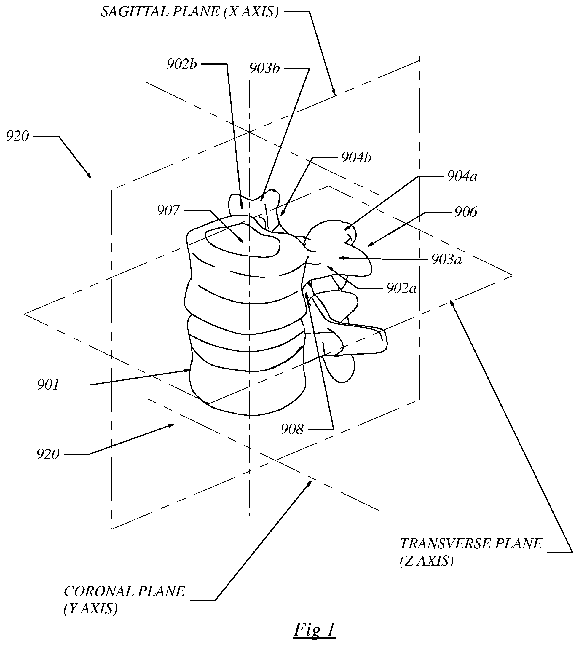 Patent US12564430 Figure 1 – Computerized process for making a patient-specific implant