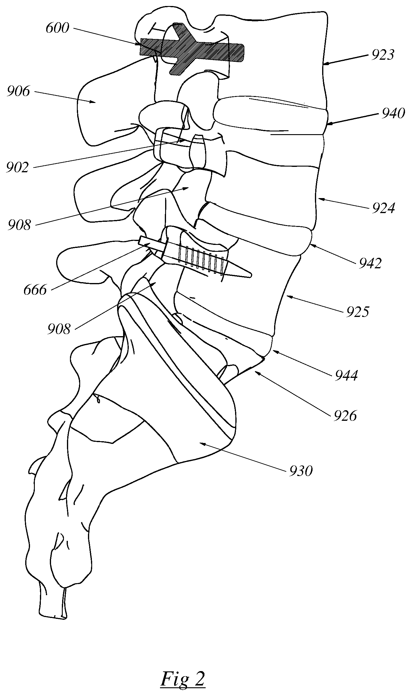 Patent US12564430 Figure 2 – Computerized process for making a patient-specific implant
