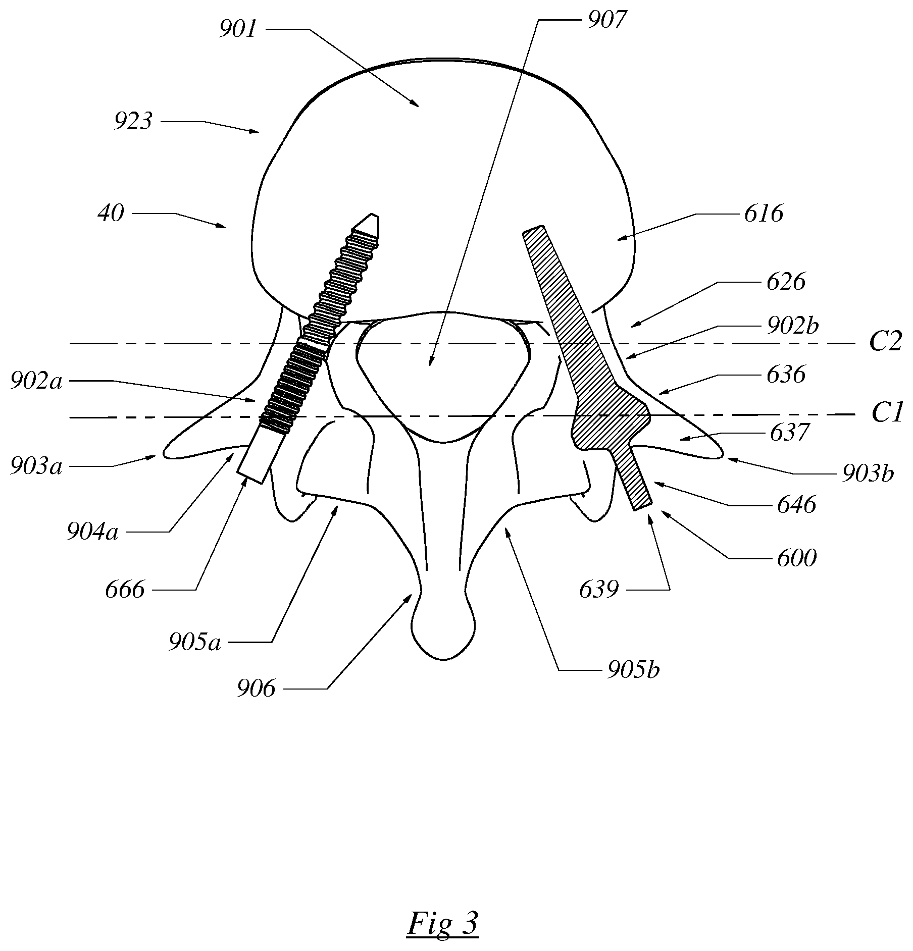 Patent US12564430 Figure 3 – Computerized process for making a patient-specific implant