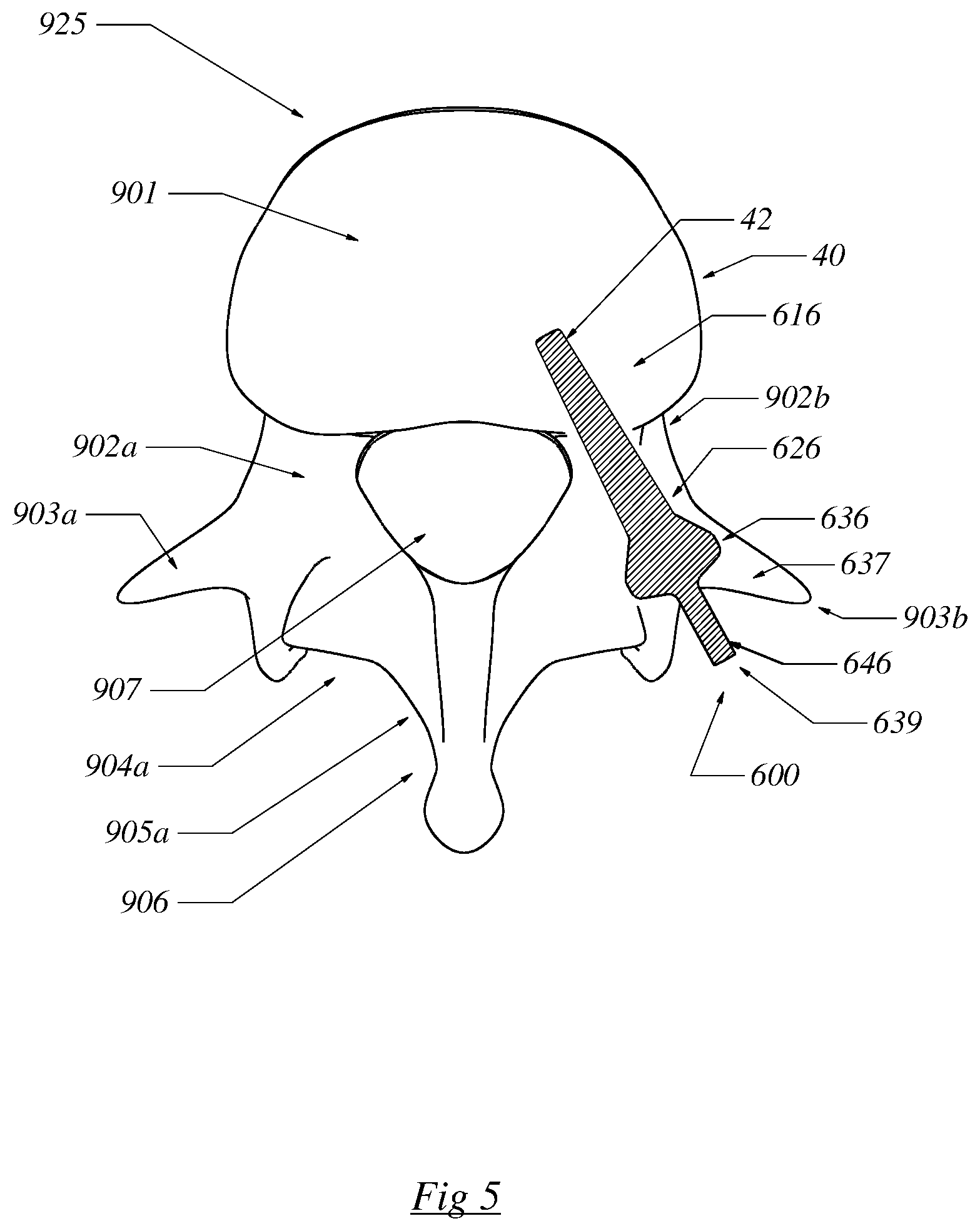 Patent US12564430 Figure 5 – Computerized process for making a patient-specific implant