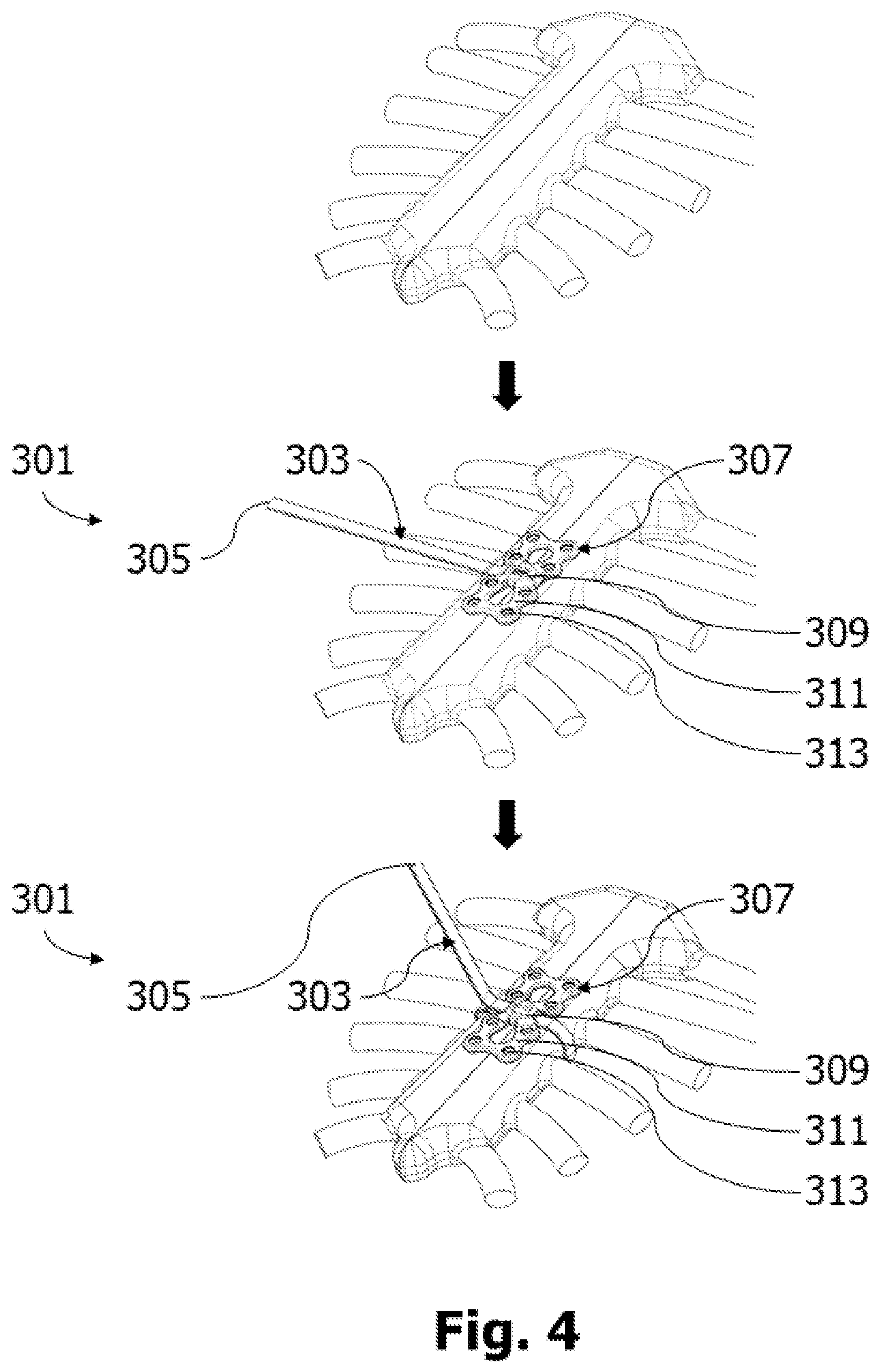 Patent US12564432 Figure 4 – Surgical tensioning instrument