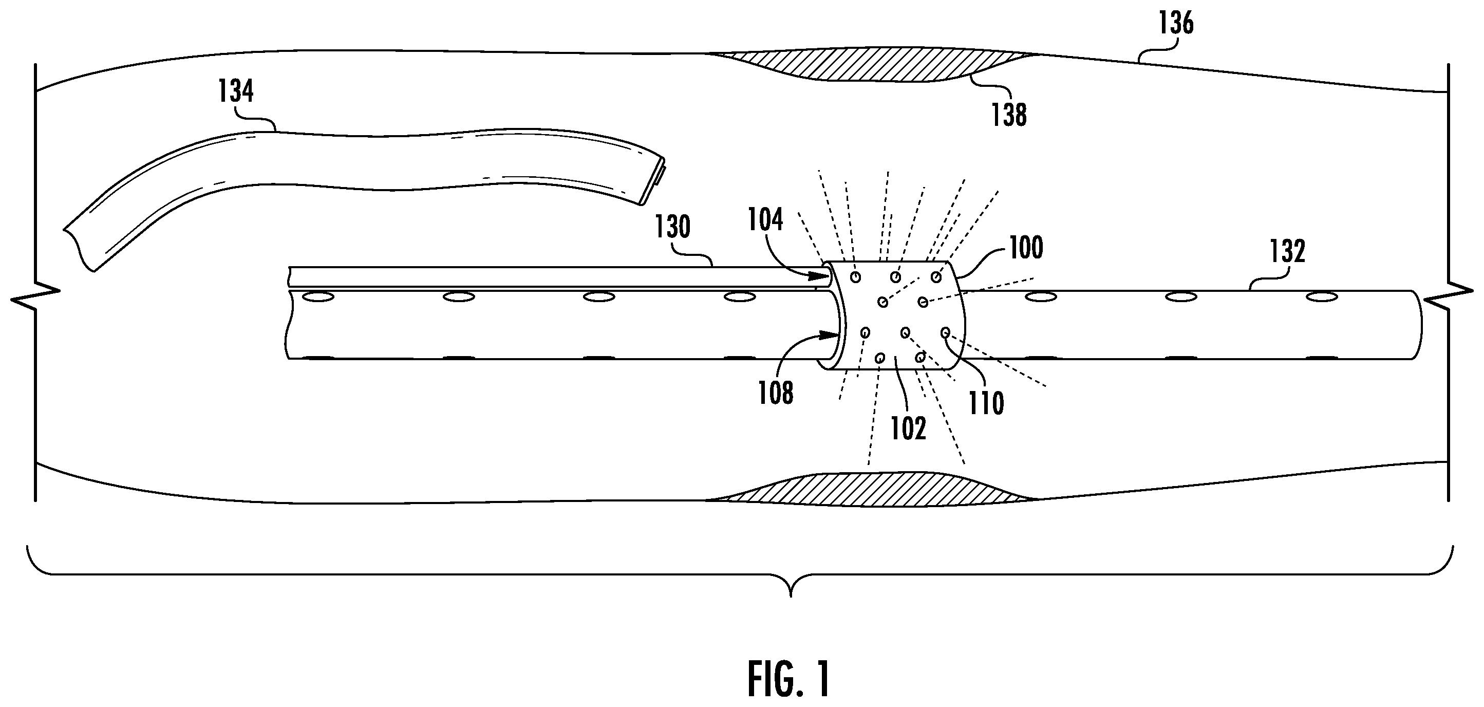 Patent US12564434 Figure 1 – Devices and methods for fluid distribution from a catheter