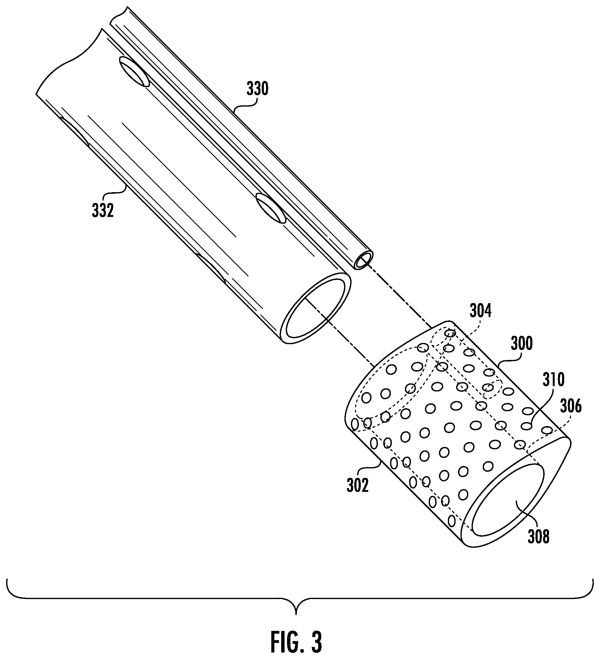 Patent US12564434 Figure 5 – Devices and methods for fluid distribution from a catheter