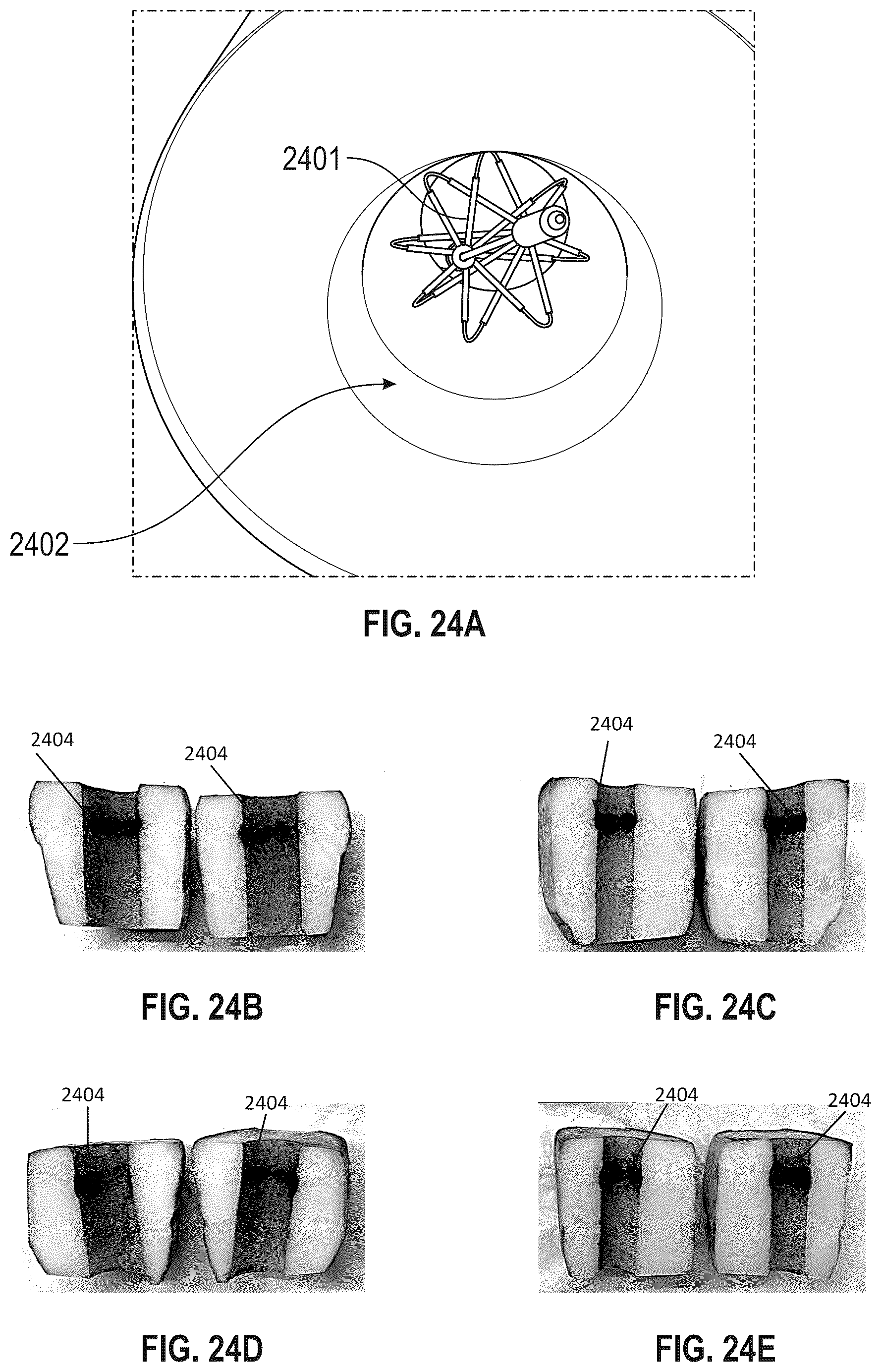 Patent US12564440 Figure 17 – Multi-strut ablation and sensing catheter devices and methods