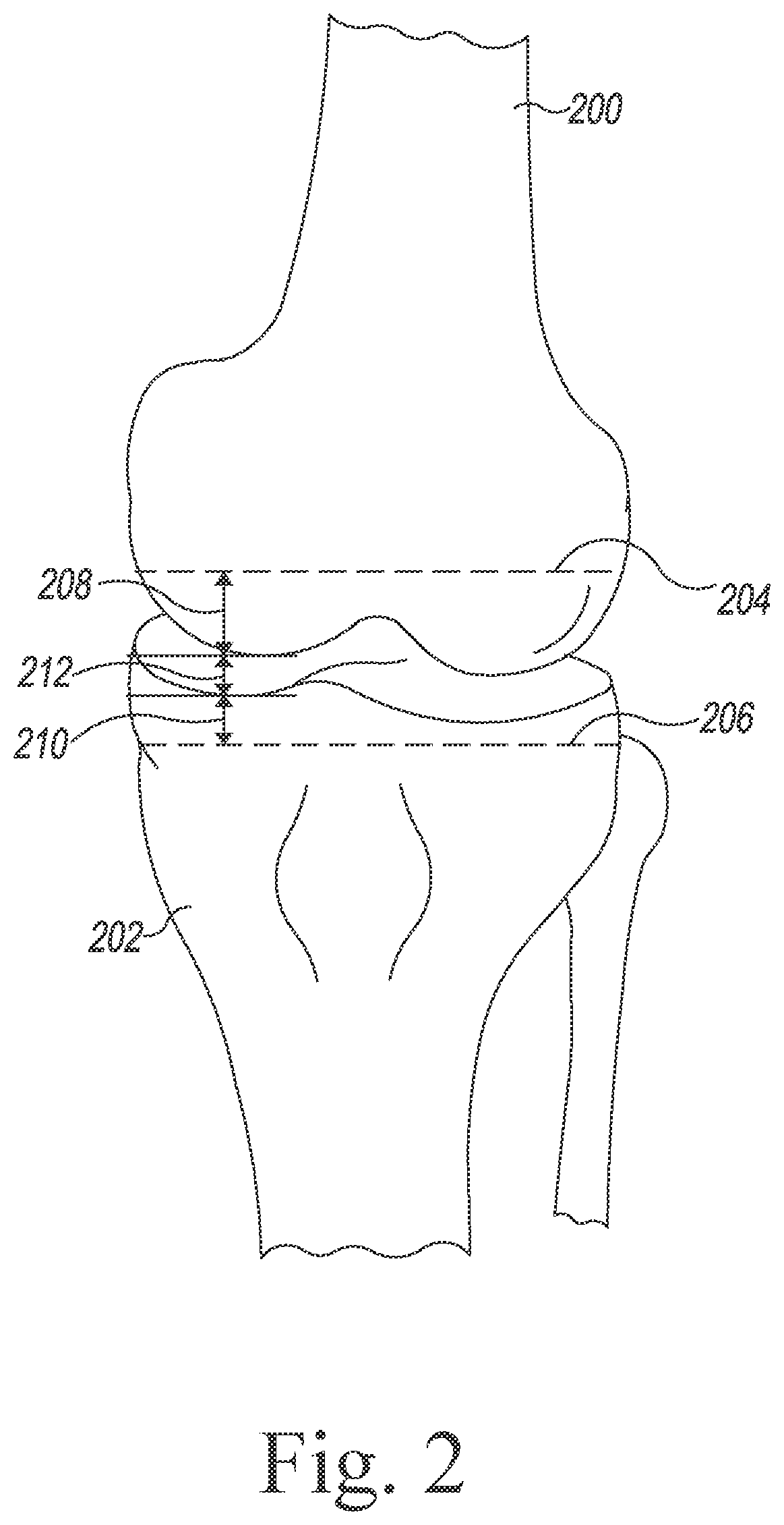 Patent US12564446 Figure 2 – Systems and methods for planning and assisting orthopaedic surgical procedures