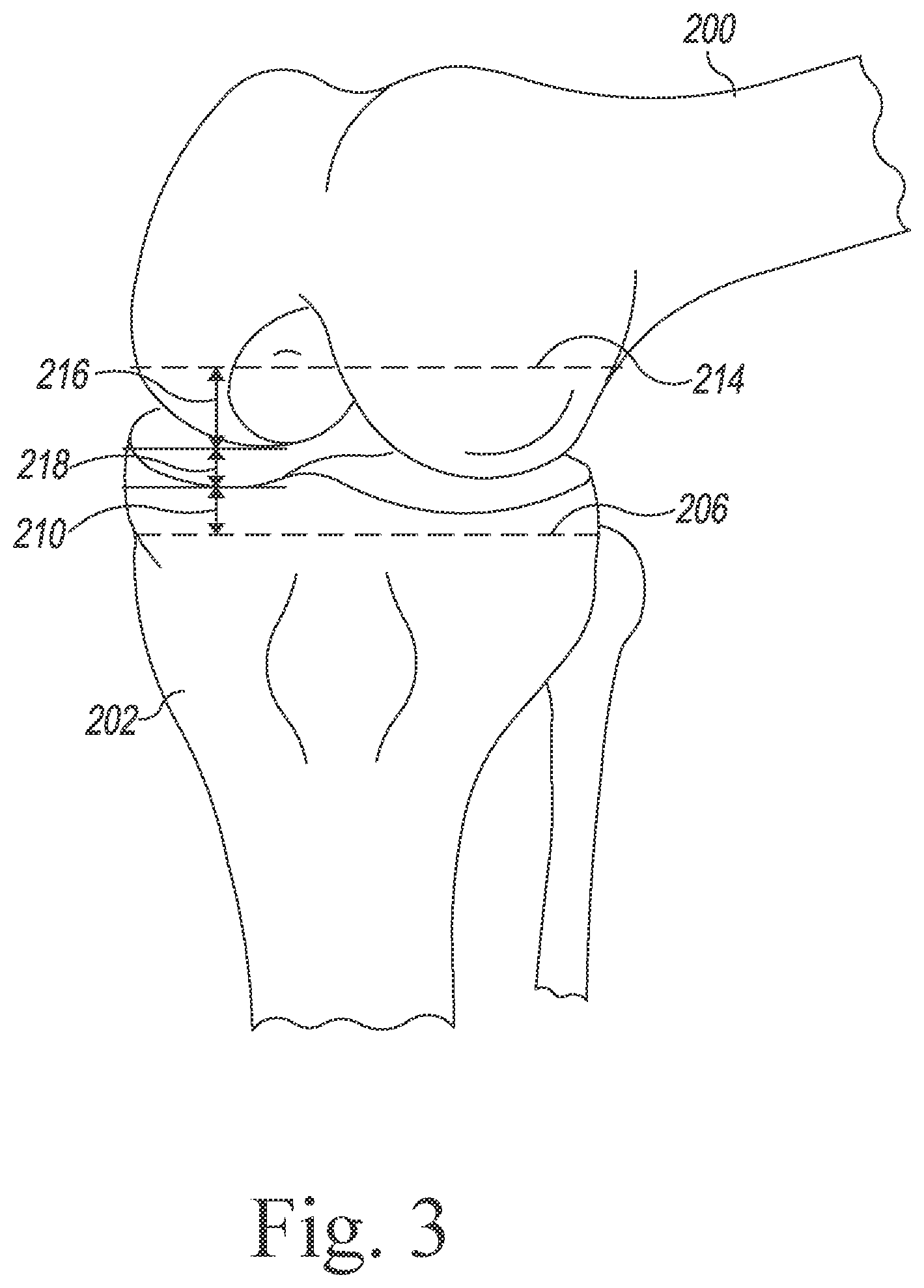 Patent US12564446 Figure 3 – Systems and methods for planning and assisting orthopaedic surgical procedures