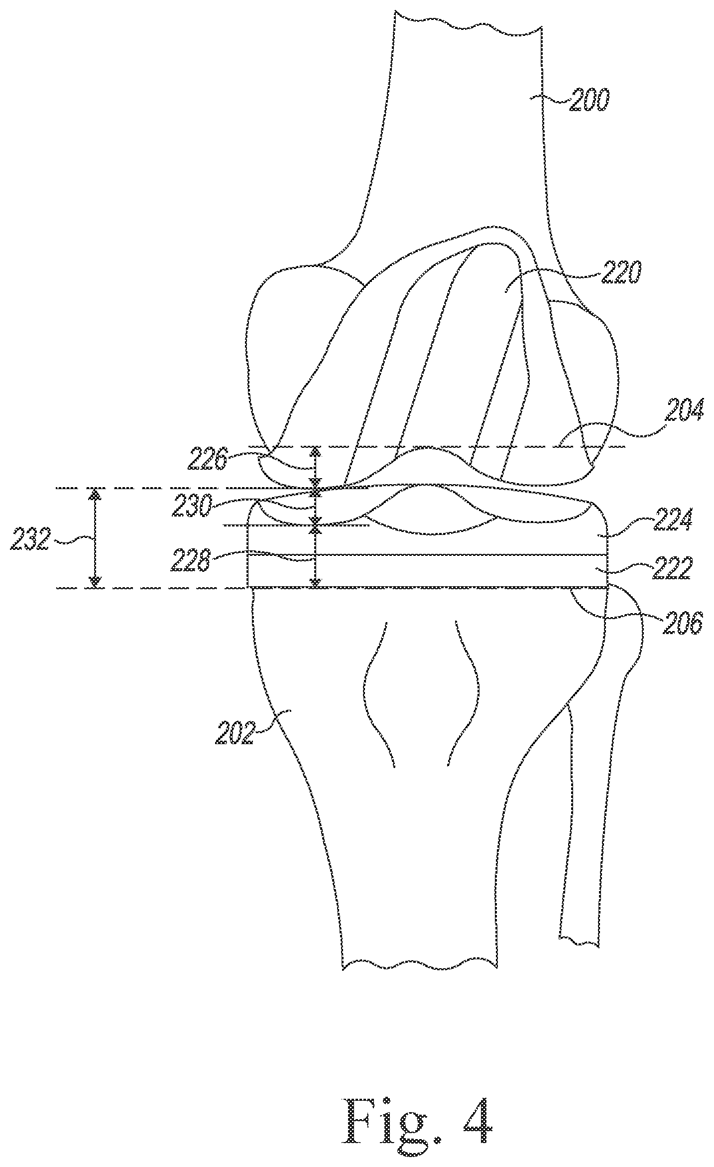 Patent US12564446 Figure 4 – Systems and methods for planning and assisting orthopaedic surgical procedures