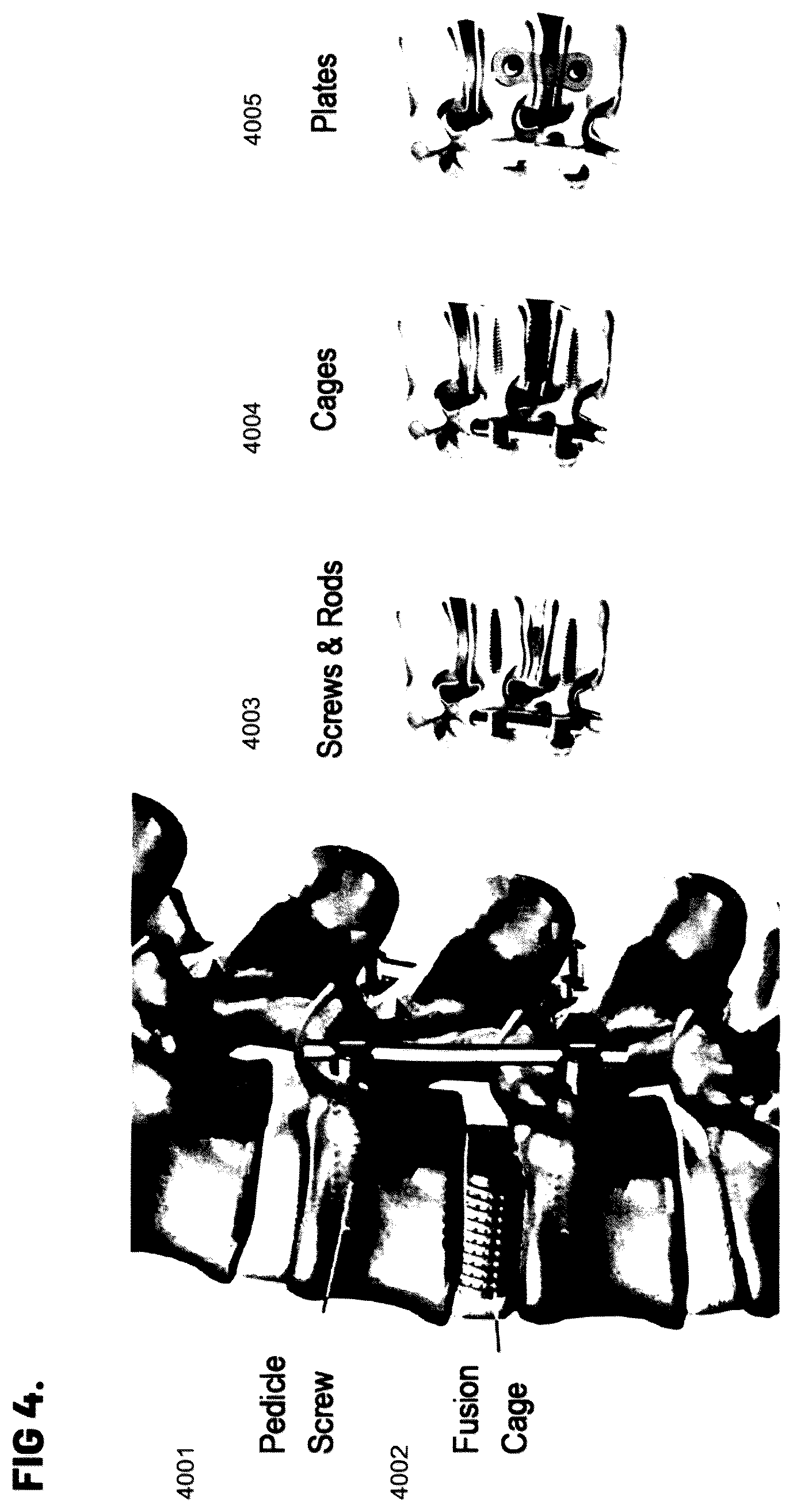 Patent US12564448 Figure 4 – Pedicle screw and implant placement prediction engine