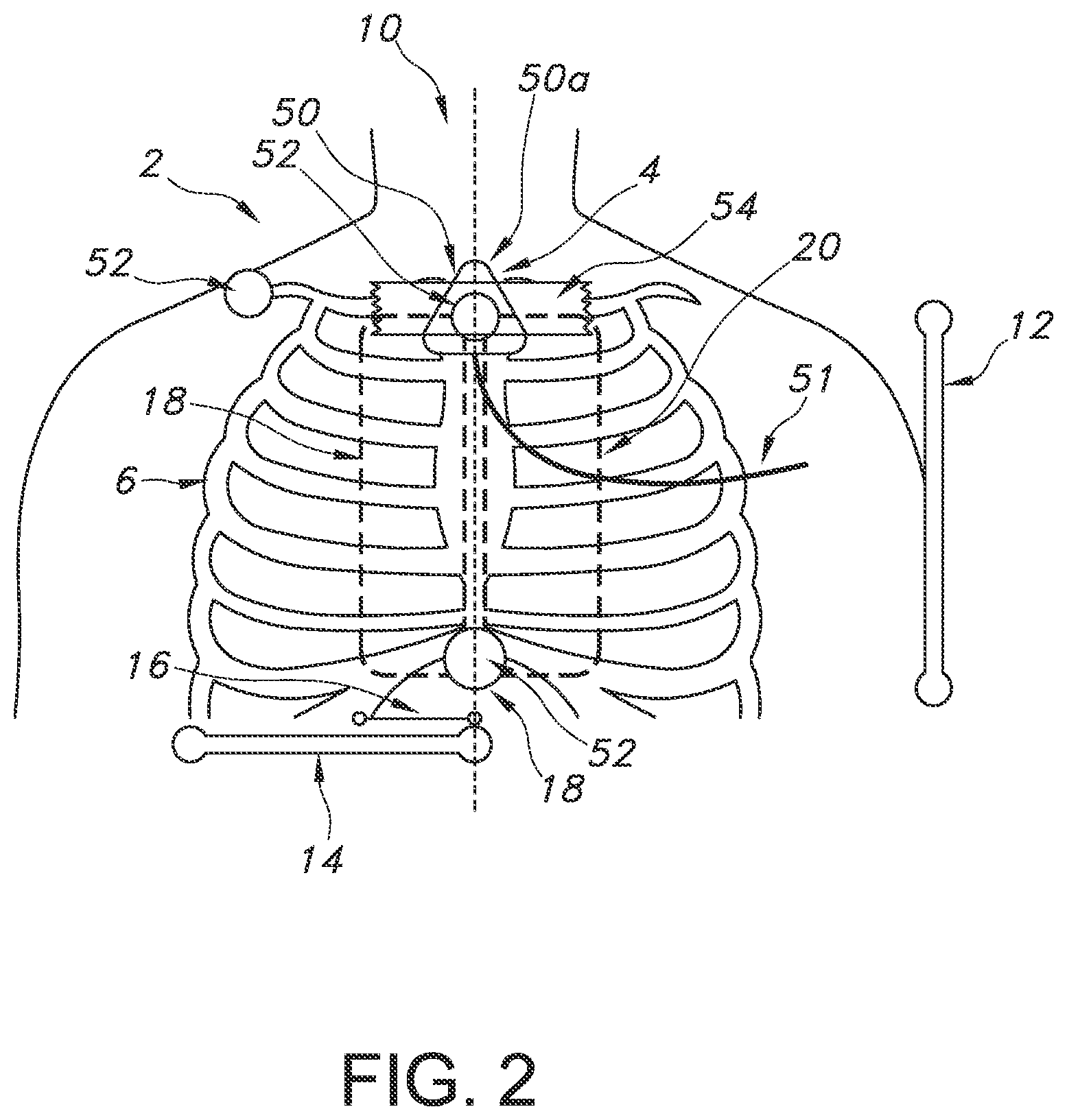 Patent US12564450 Figure 2 – Configurable system and method for indicating deviation from a medical device placement pathway
