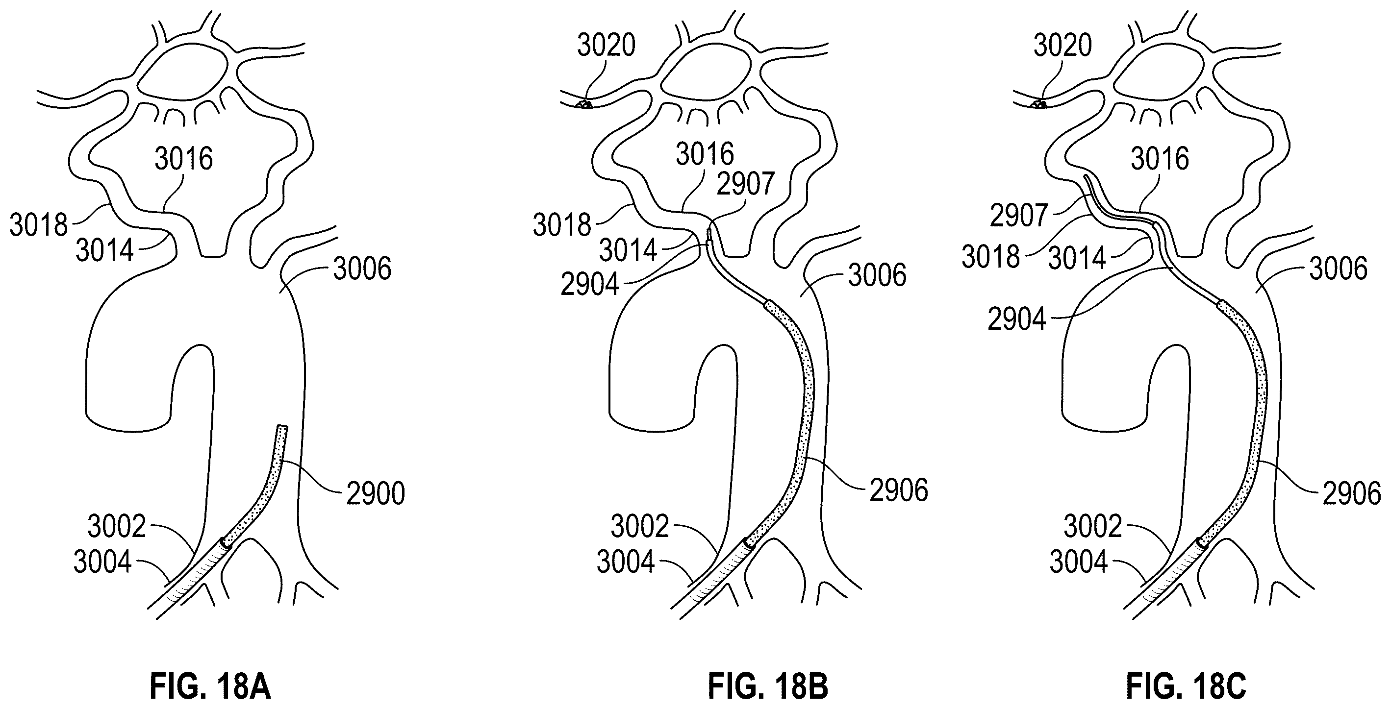 Patent US12564458 Figure 20 – Method of robotically driving a multi catheter assembly above the aortic arch
