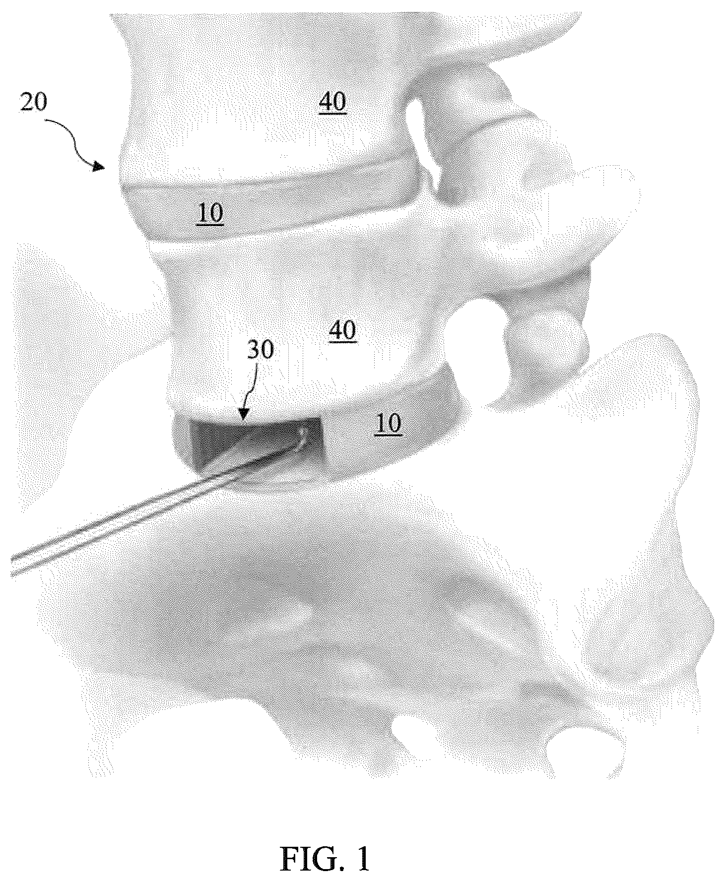 Patent US12564468 Figure 1 – Implant load feedback apparatus