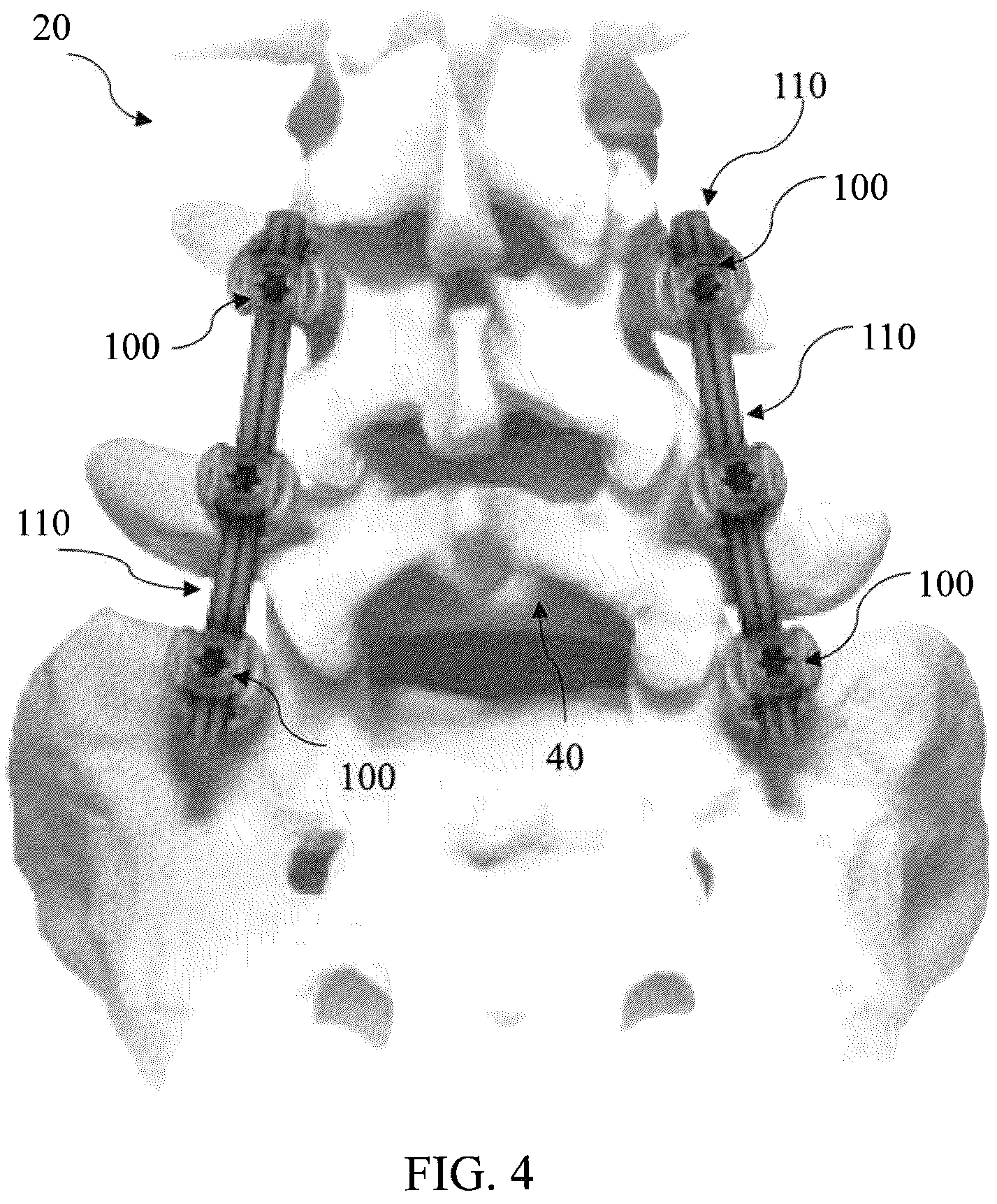 Patent US12564468 Figure 4 – Implant load feedback apparatus