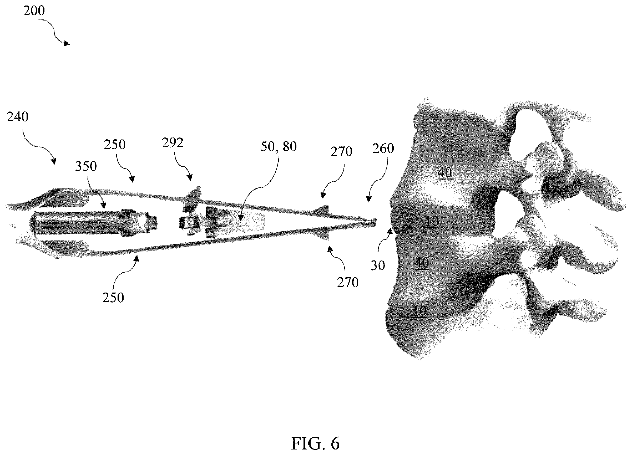 Patent US12564468 Figure 6 – Implant load feedback apparatus