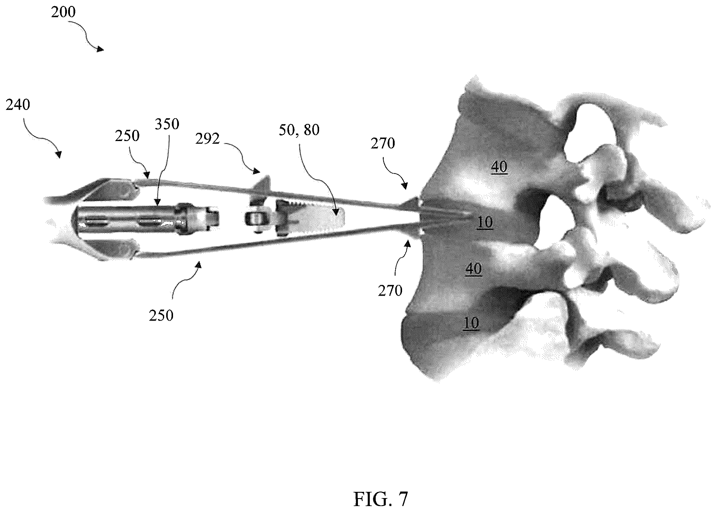 Patent US12564468 Figure 7 – Implant load feedback apparatus