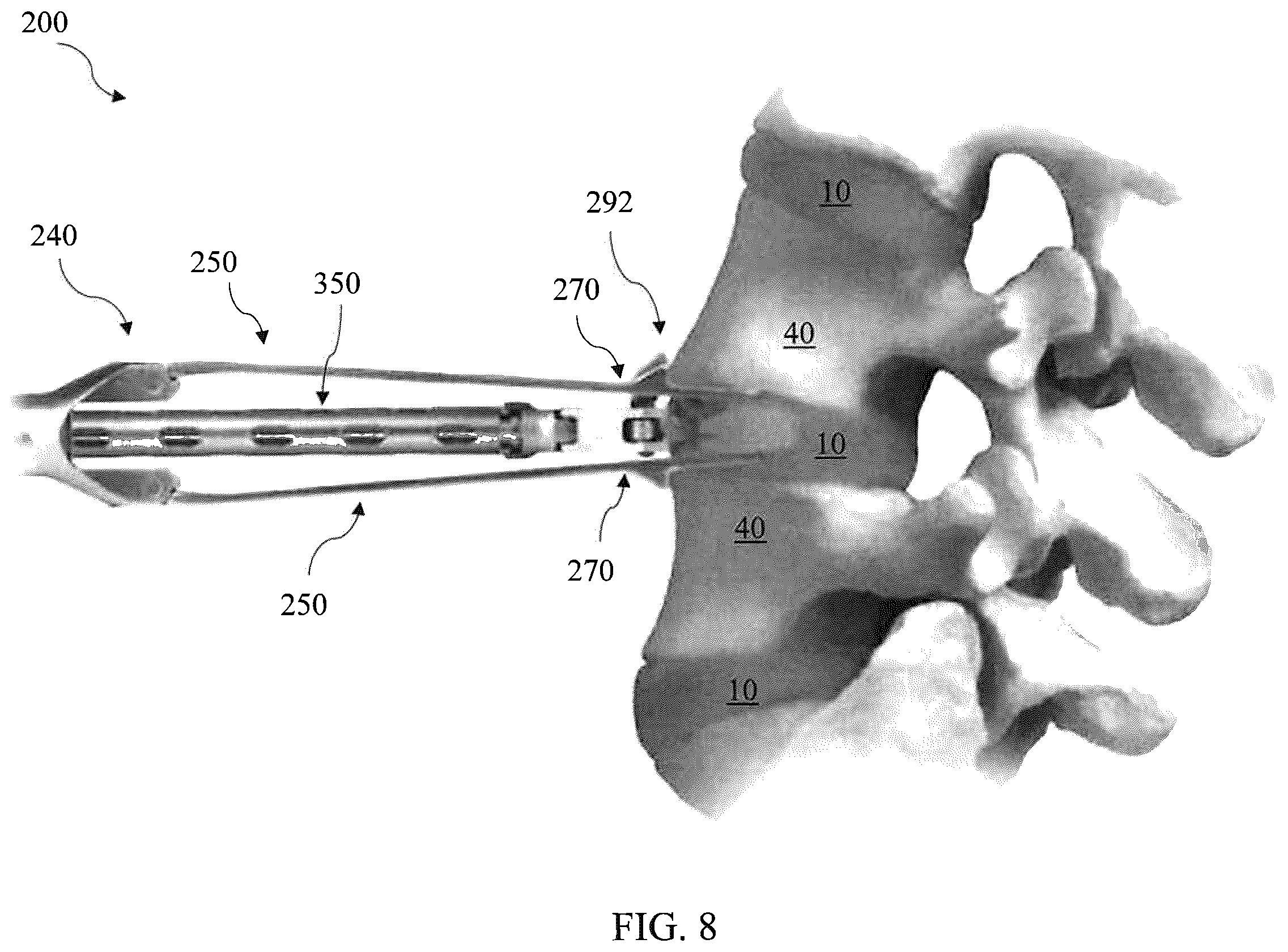 Patent US12564468 Figure 8 – Implant load feedback apparatus