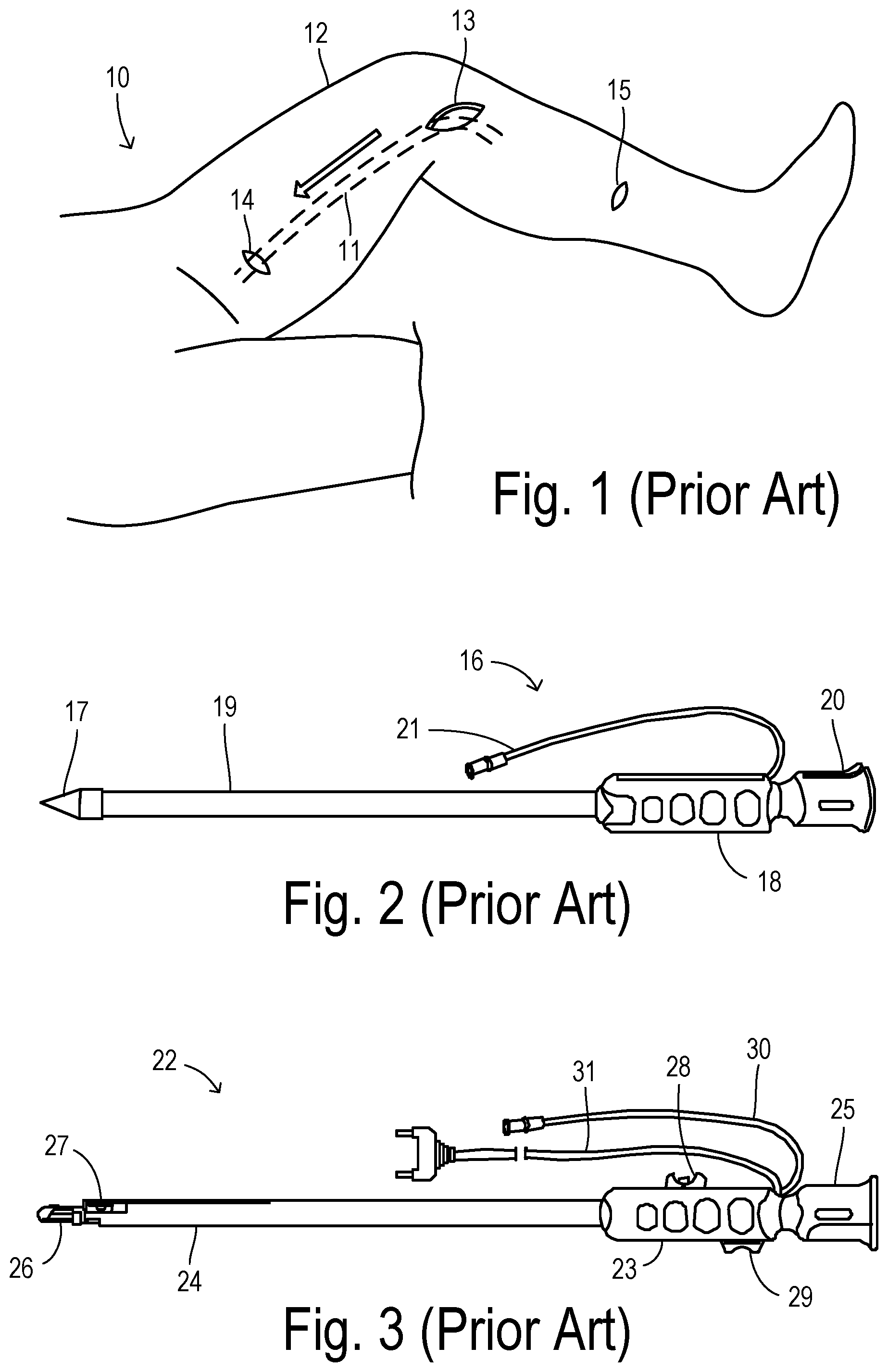 Patent US12564471 Figure 1 – Augmented-reality endoscopic vessel harvesting