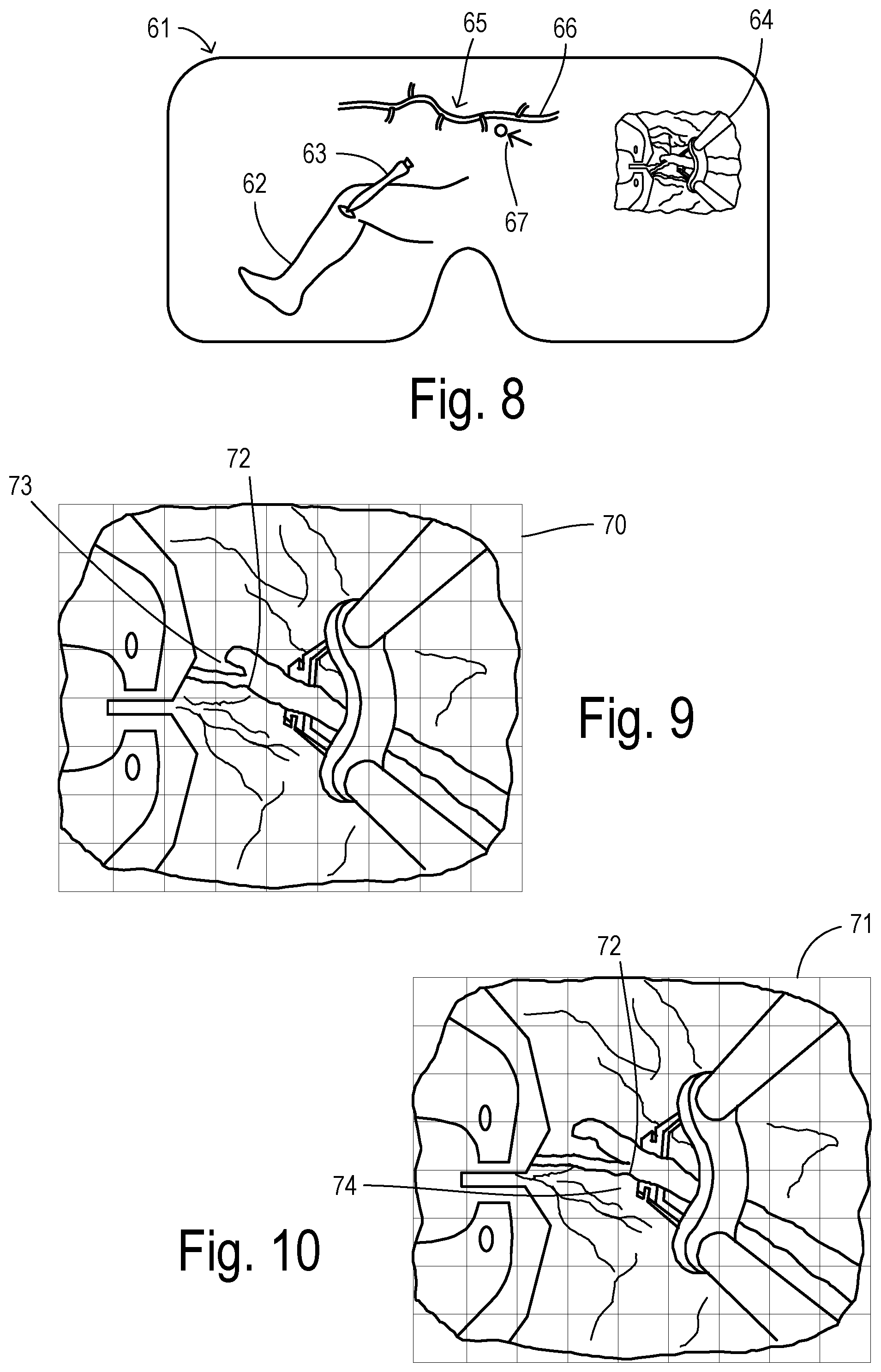 Patent US12564471 Figure 4 – Augmented-reality endoscopic vessel harvesting