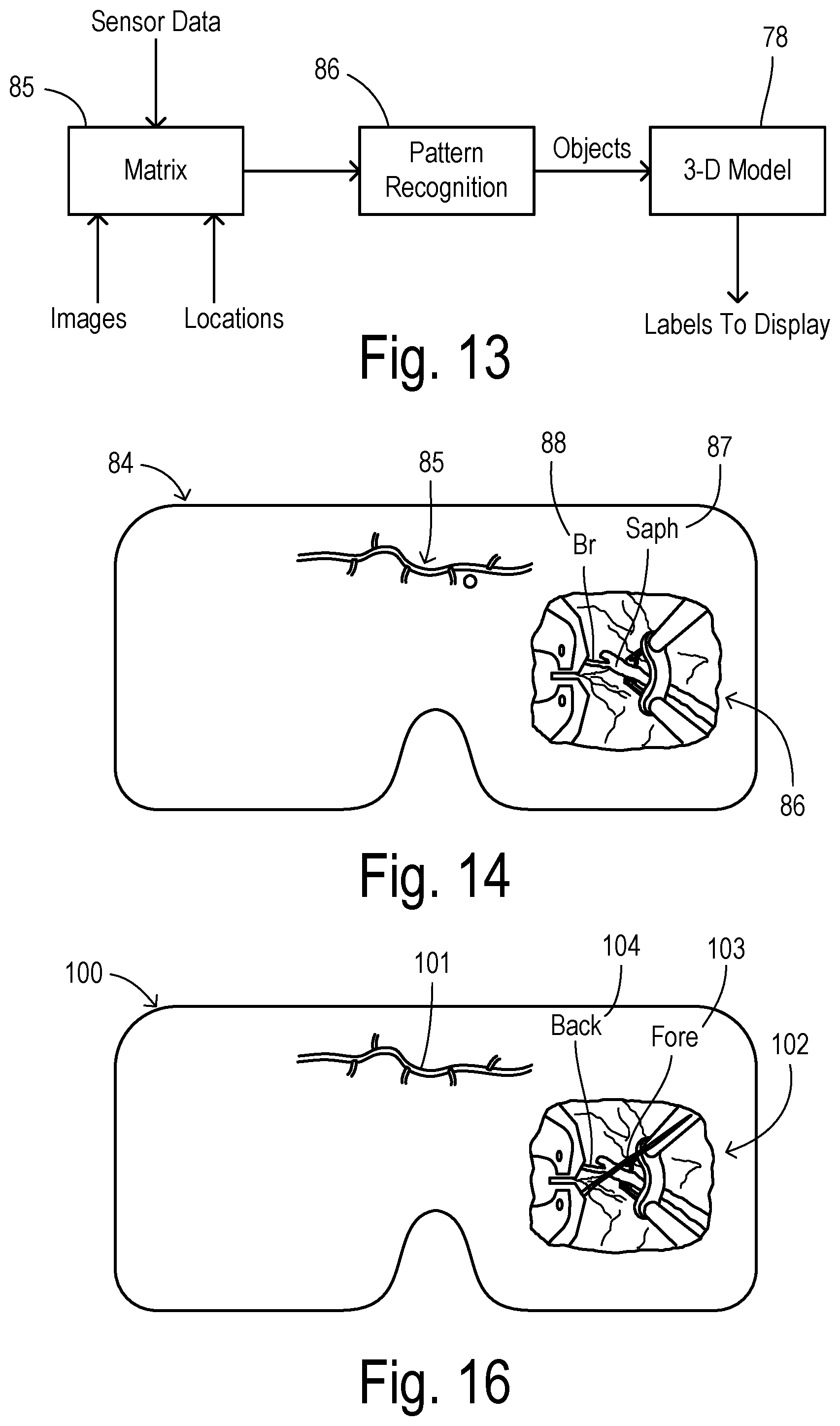 Patent US12564471 Figure 6 – Augmented-reality endoscopic vessel harvesting