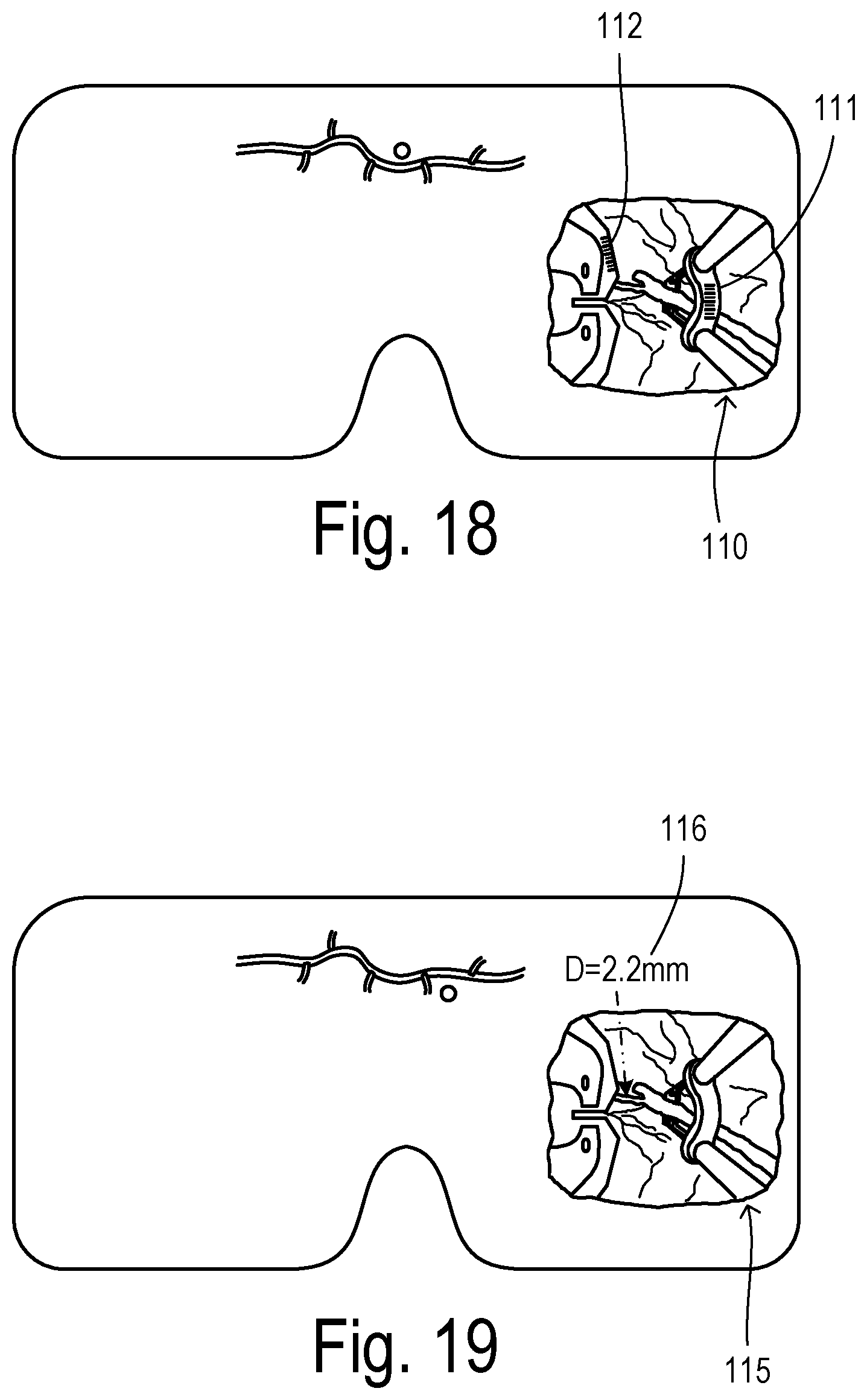 Patent US12564471 Figure 8 – Augmented-reality endoscopic vessel harvesting