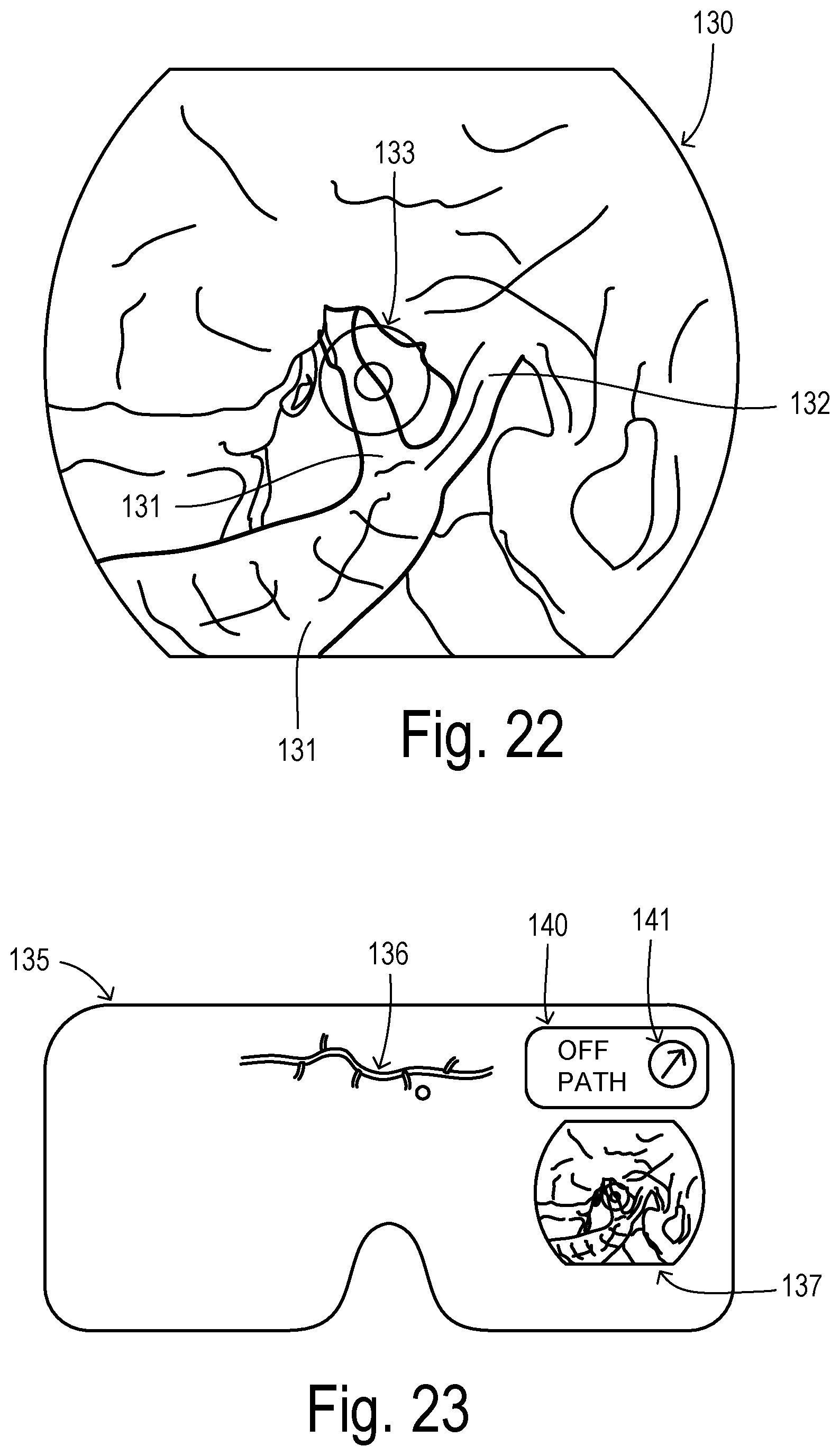 Patent US12564471 Figure 10 – Augmented-reality endoscopic vessel harvesting