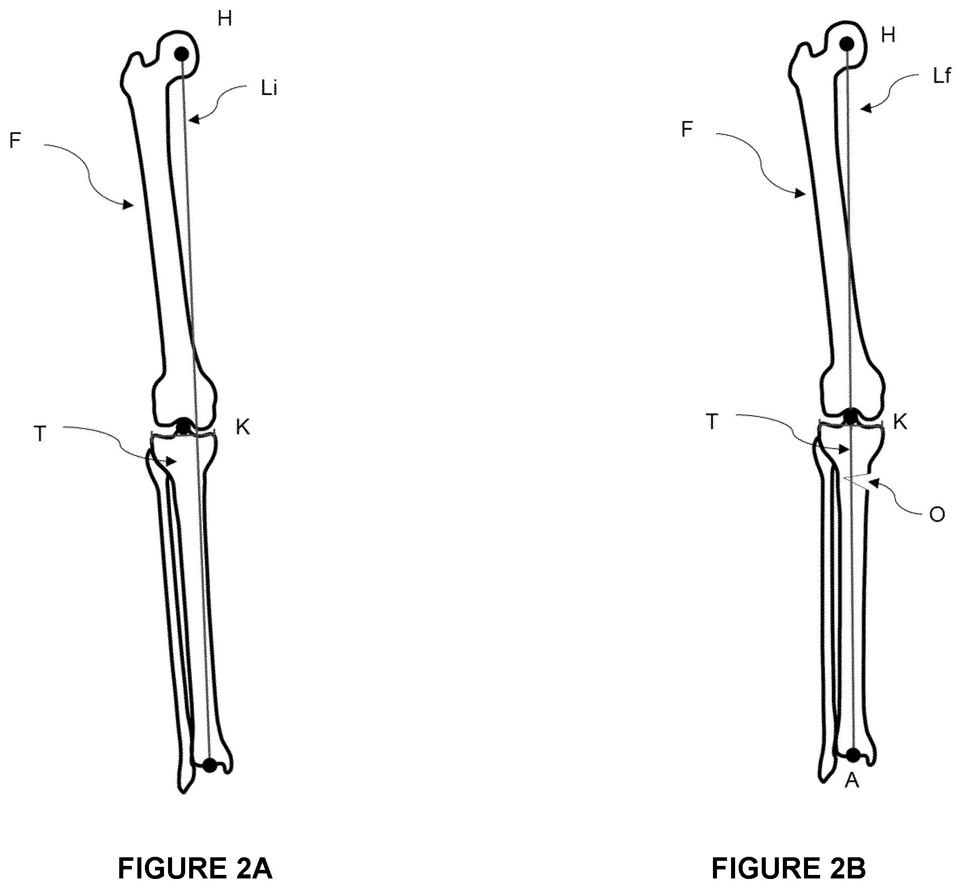 Patent US12564472 Figure 2 – System for guiding an osteotomy procedure