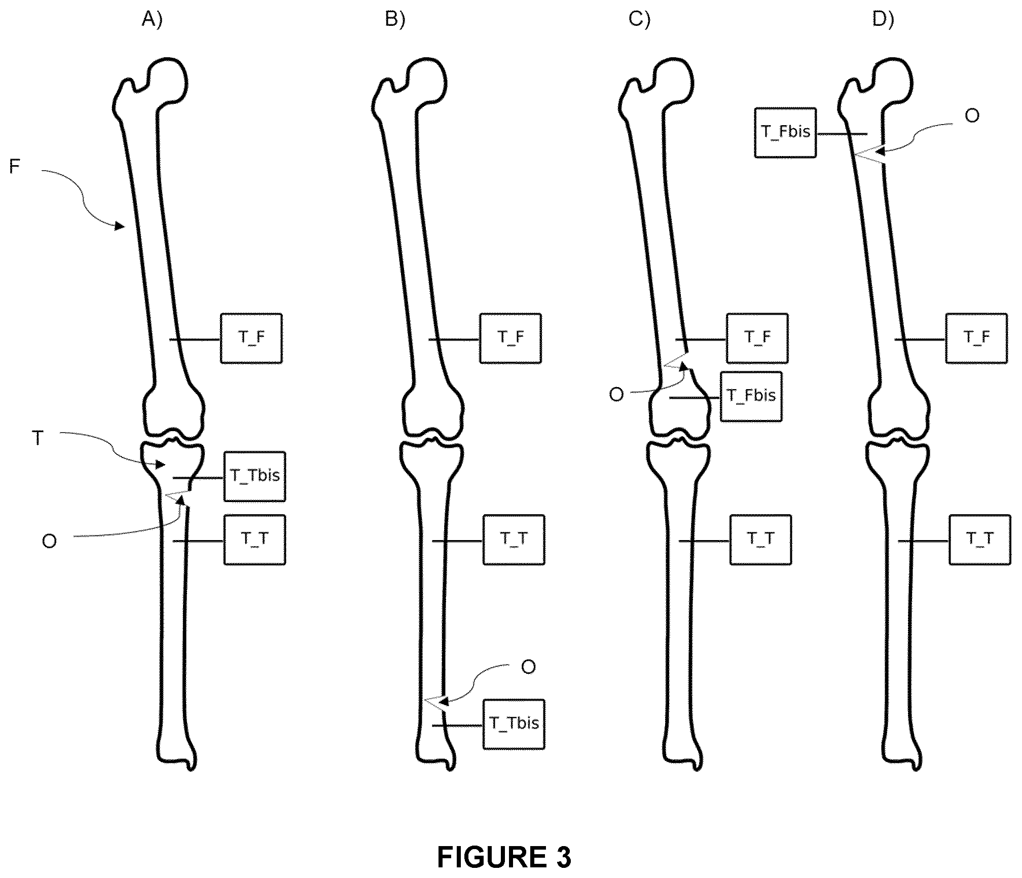 Patent US12564472 Figure 3 – System for guiding an osteotomy procedure