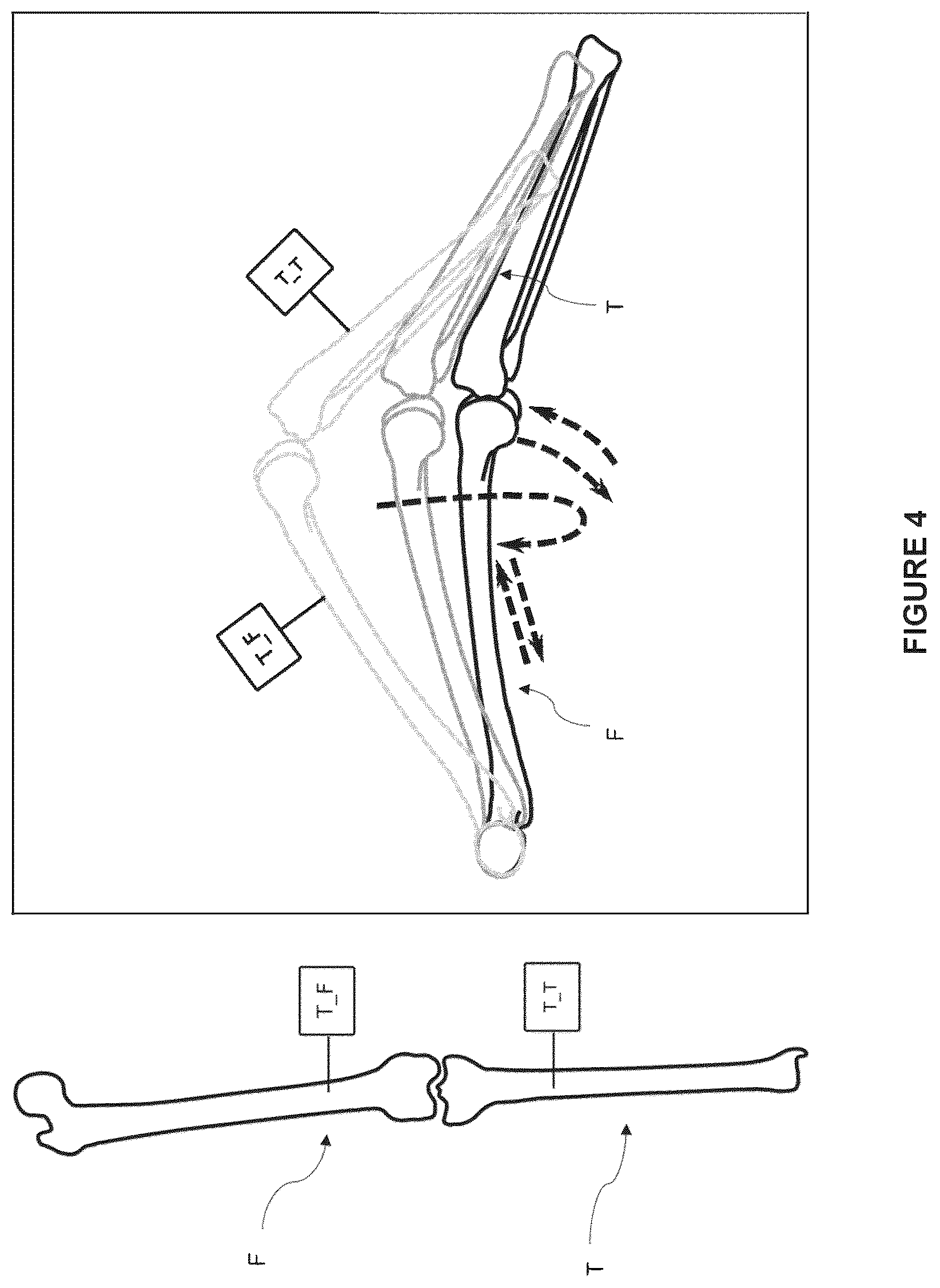 Patent US12564472 Figure 4 – System for guiding an osteotomy procedure