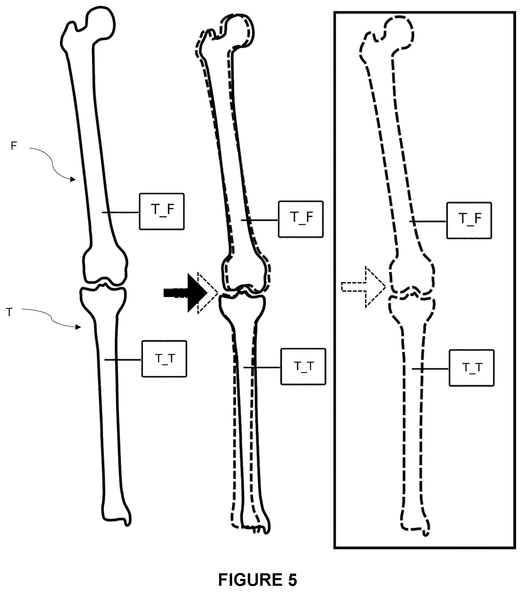 Patent US12564472 Figure 5 – System for guiding an osteotomy procedure