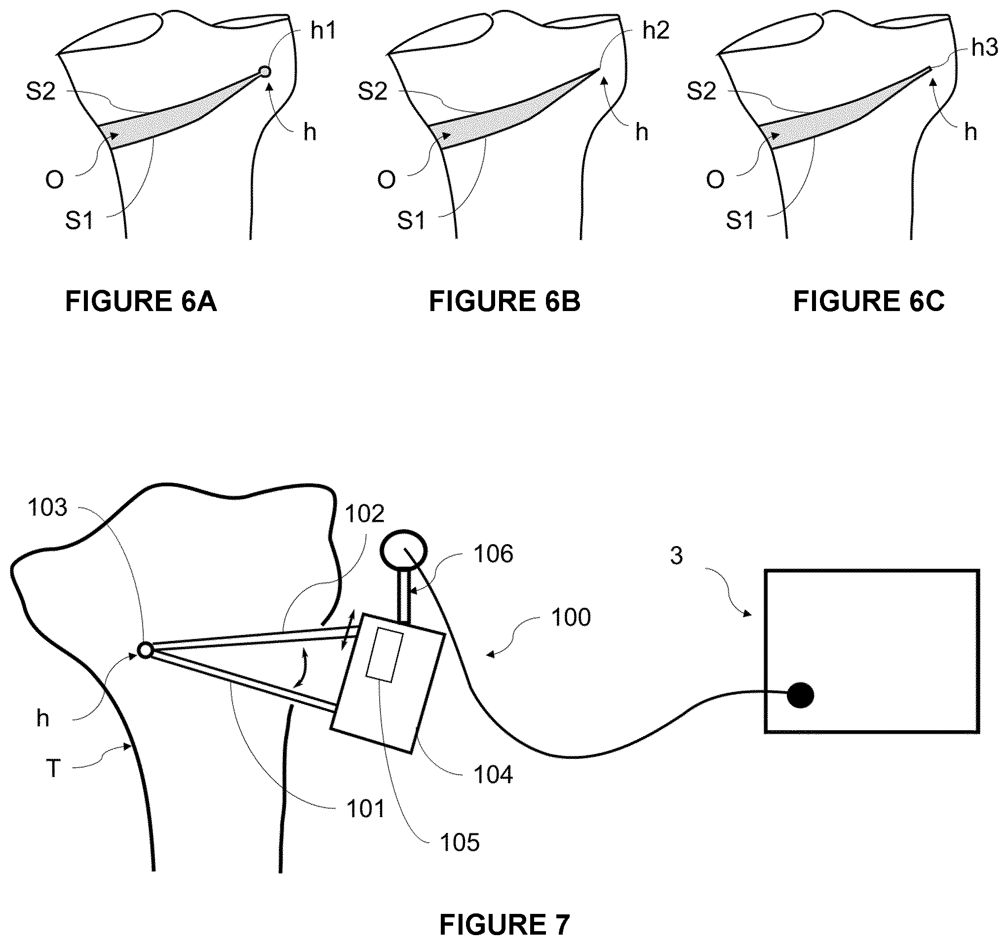 Patent US12564472 Figure 6 – System for guiding an osteotomy procedure