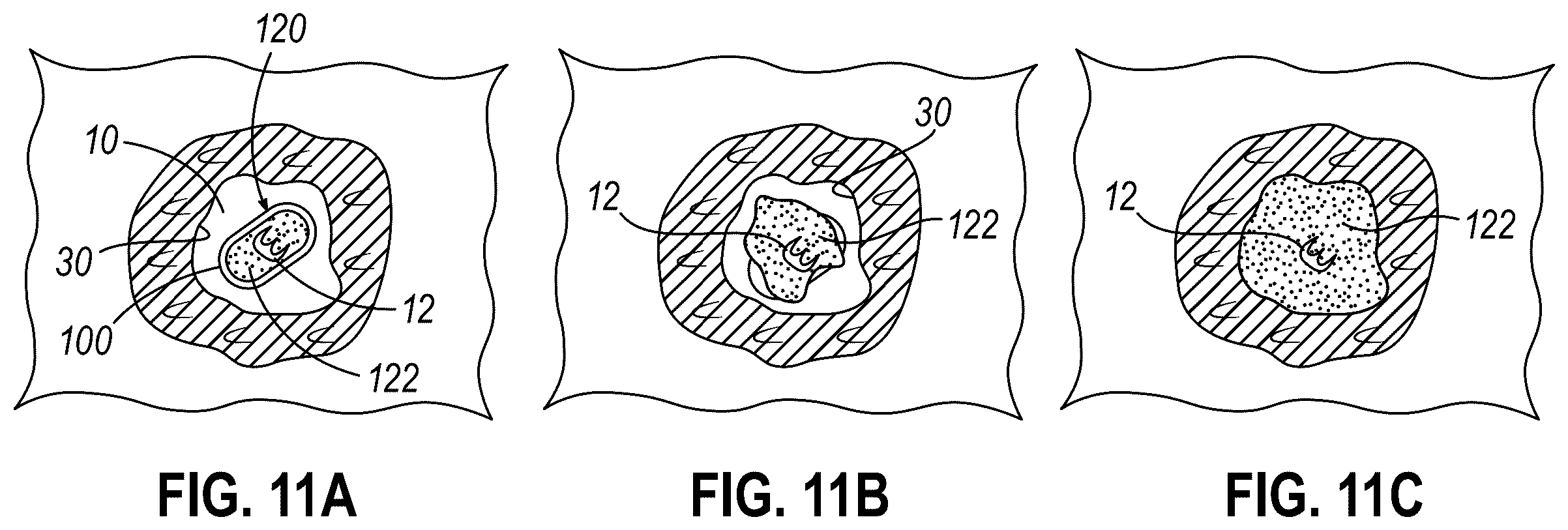 Patent US12564473 Figure 11 – Biopsy site marker having movable portions