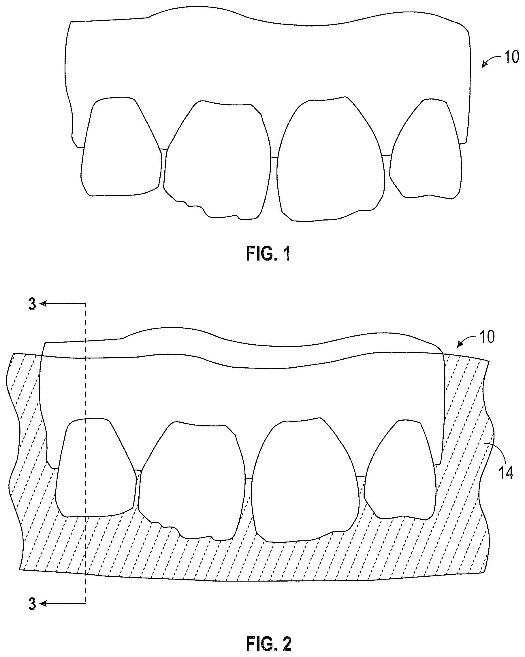 Patent US12564476 Figure 1 – Device and kit for injection bonding multi-tooth dental restoration in a single treatment