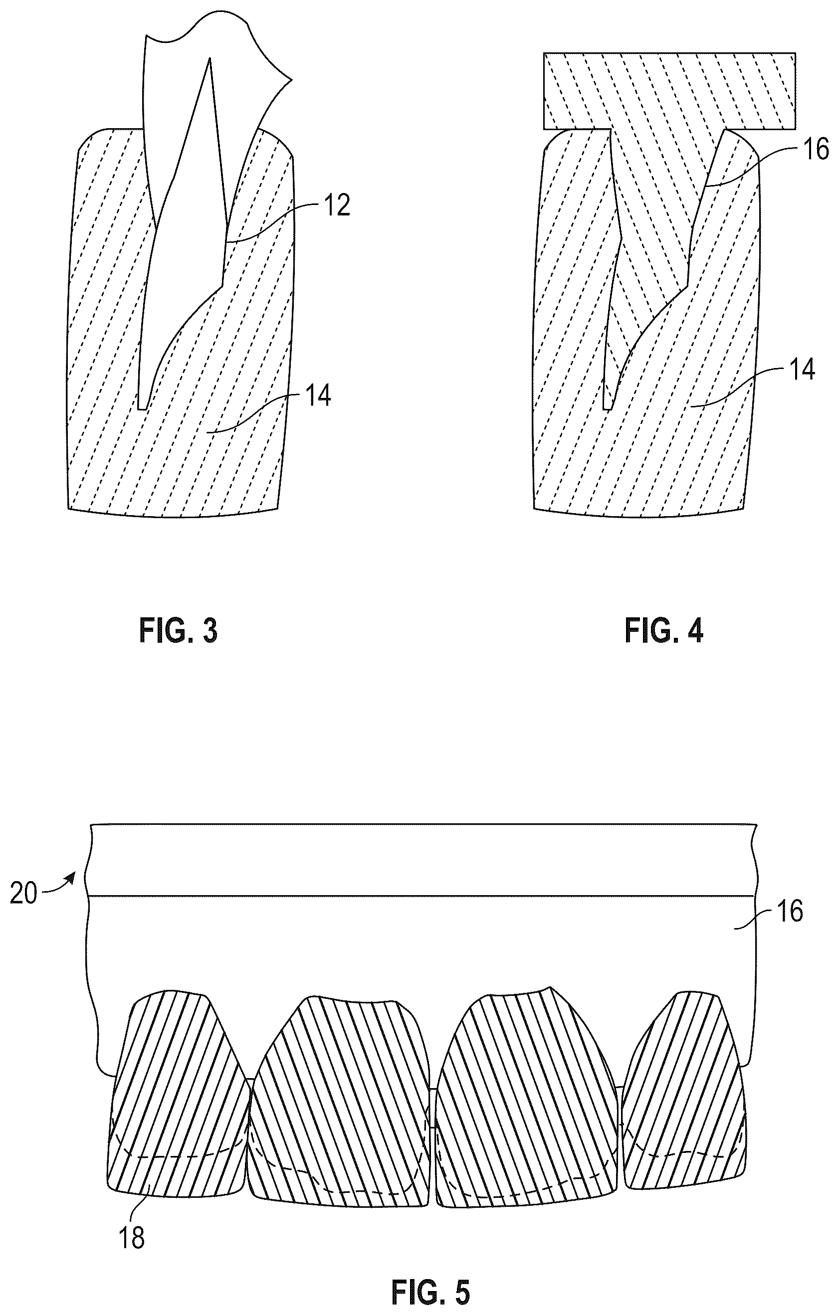 Patent US12564476 Figure 2 – Device and kit for injection bonding multi-tooth dental restoration in a single treatment