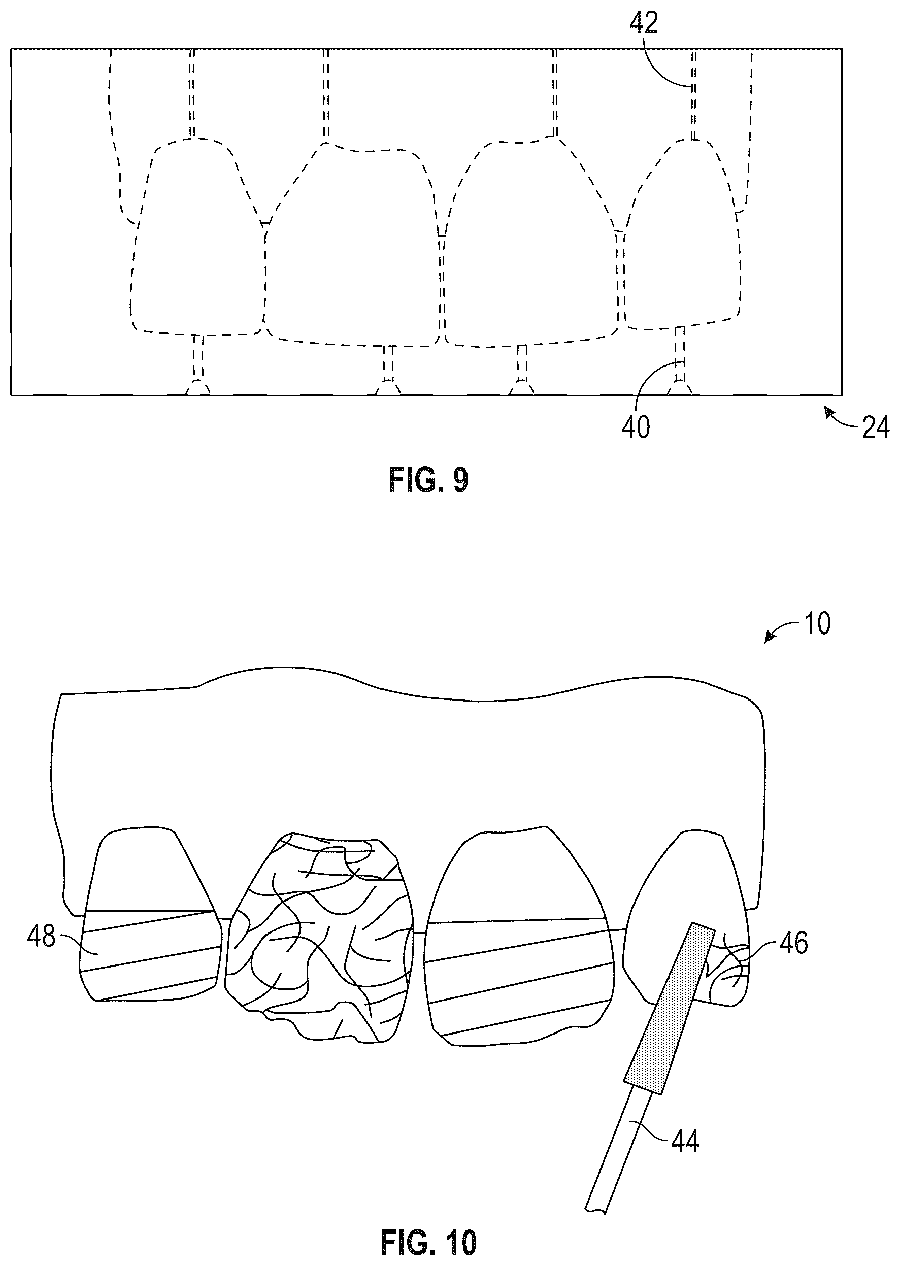 Patent US12564476 Figure 4 – Device and kit for injection bonding multi-tooth dental restoration in a single treatment