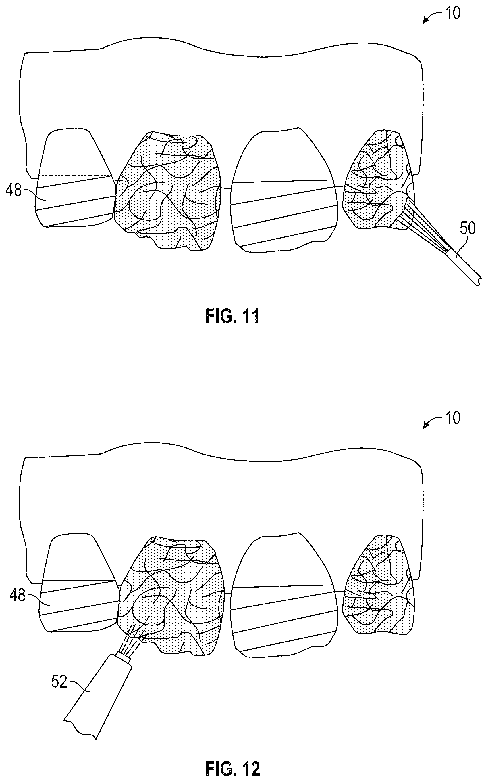 Patent US12564476 Figure 5 – Device and kit for injection bonding multi-tooth dental restoration in a single treatment