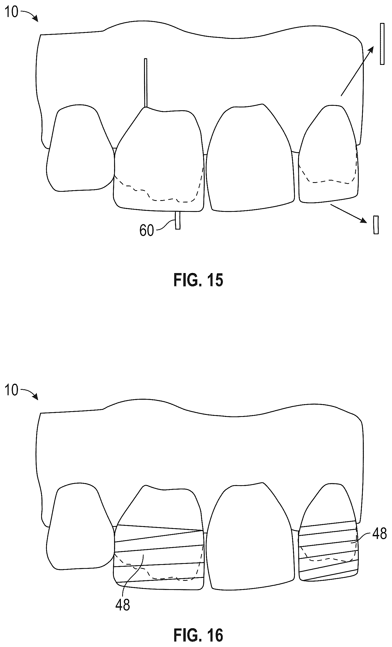 Patent US12564476 Figure 7 – Device and kit for injection bonding multi-tooth dental restoration in a single treatment
