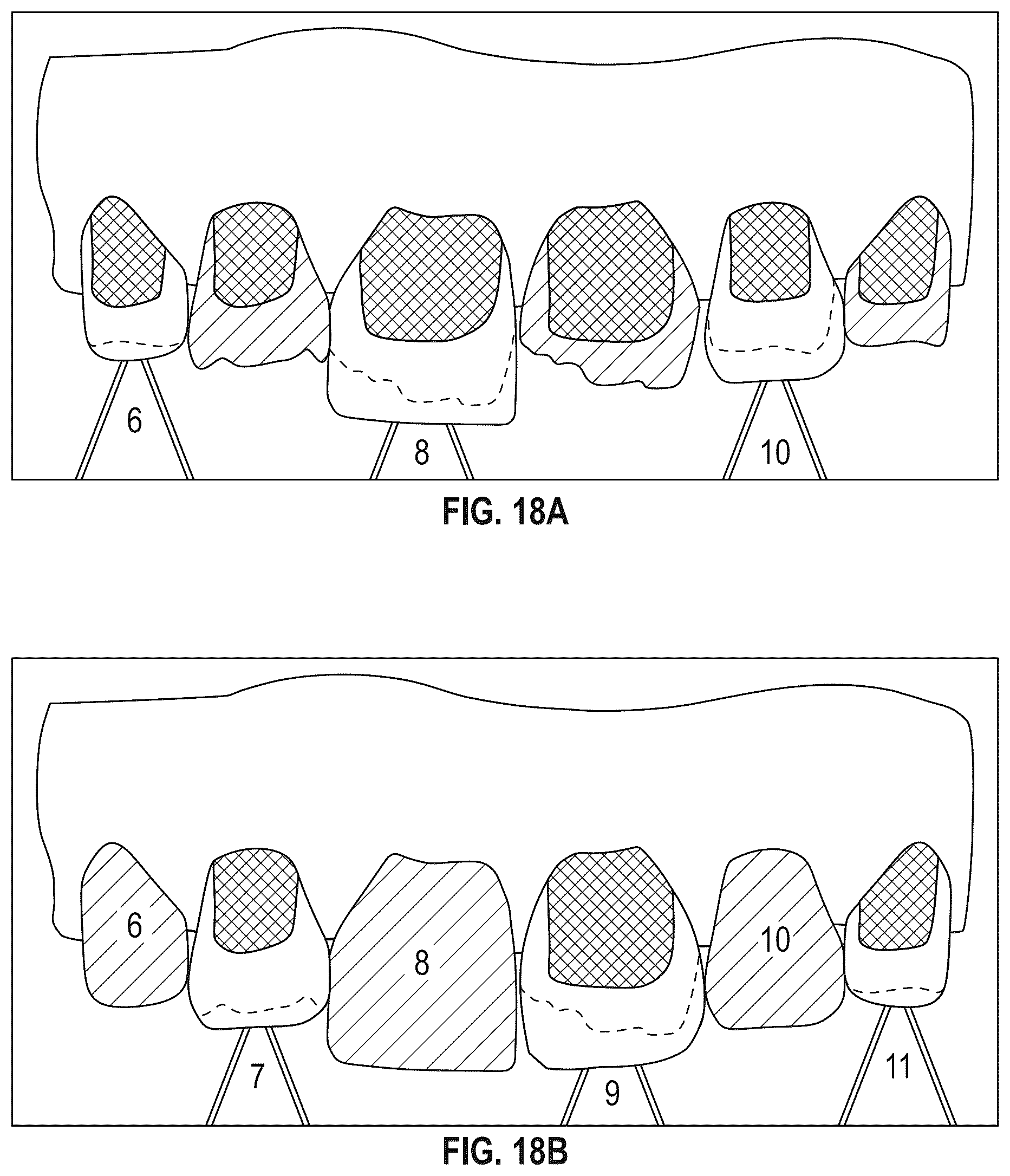 Patent US12564476 Figure 9 – Device and kit for injection bonding multi-tooth dental restoration in a single treatment