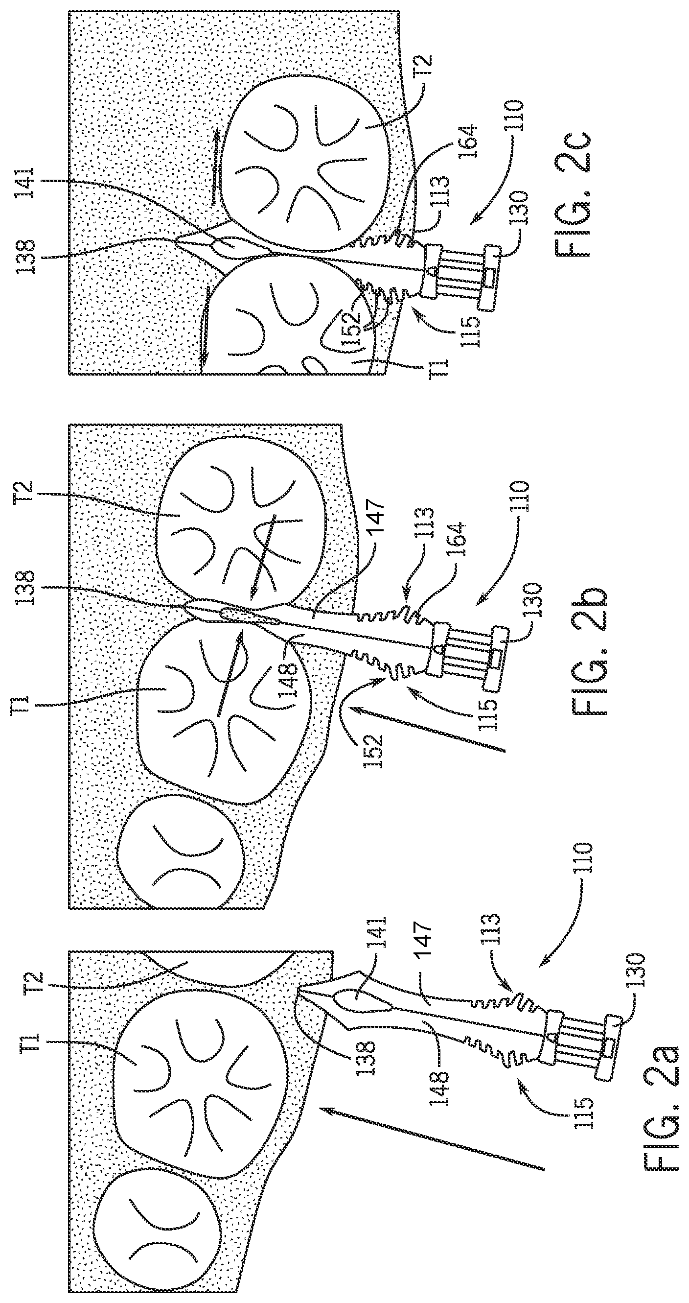 Patent US12564477 Figure 2 – Dental wedge