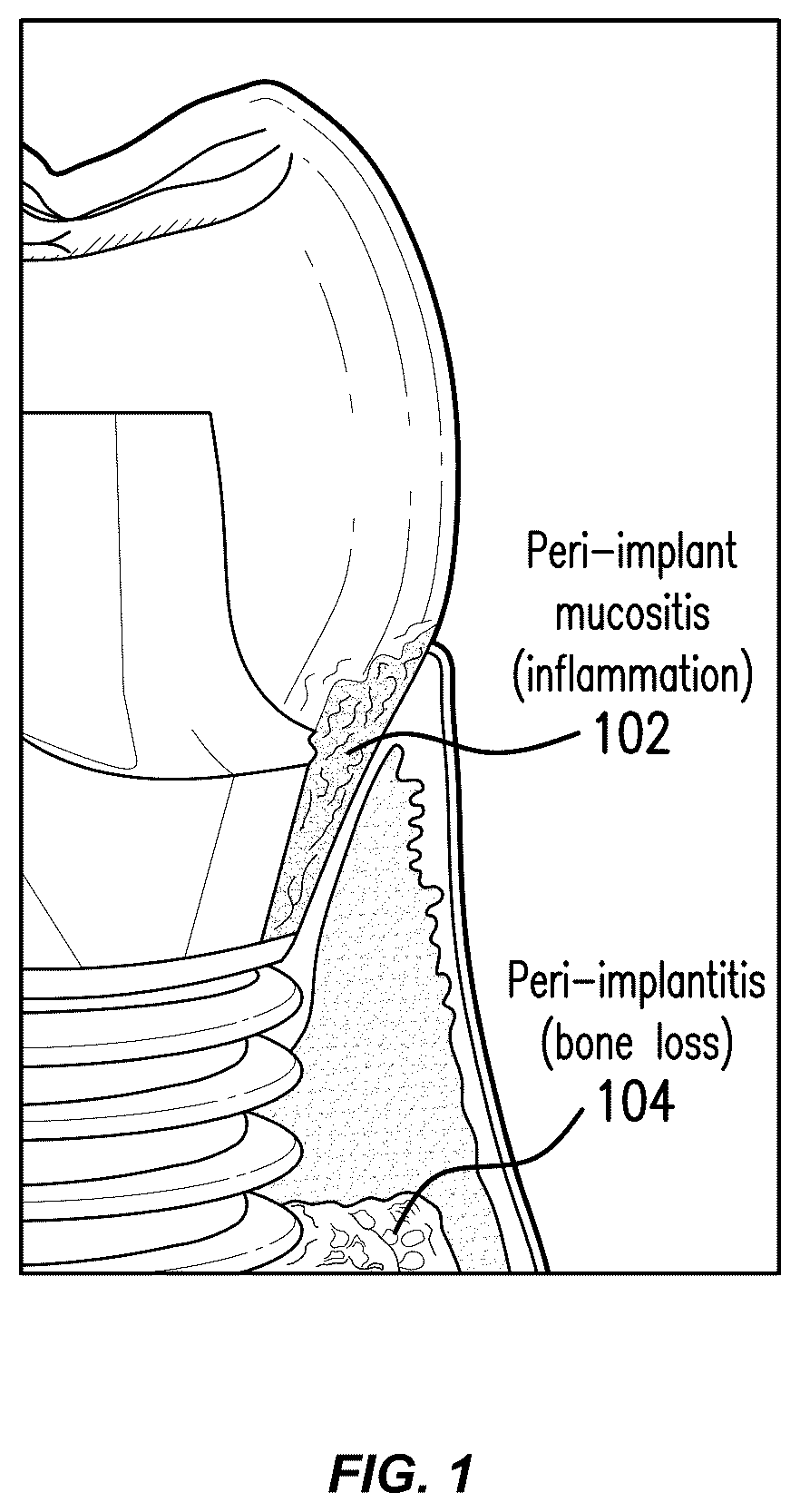 Patent US12564480 — Smart dental implant system for ambulatory dental care — Figure 1