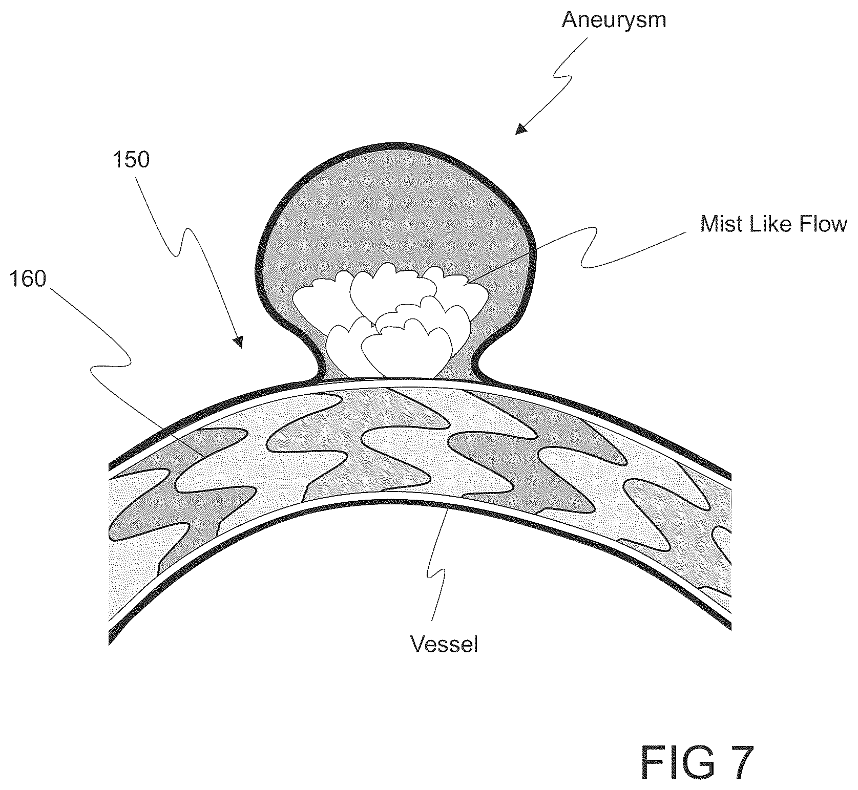 Patent US12564486 Figure 11 – Devices and methods for treating an aneurysm