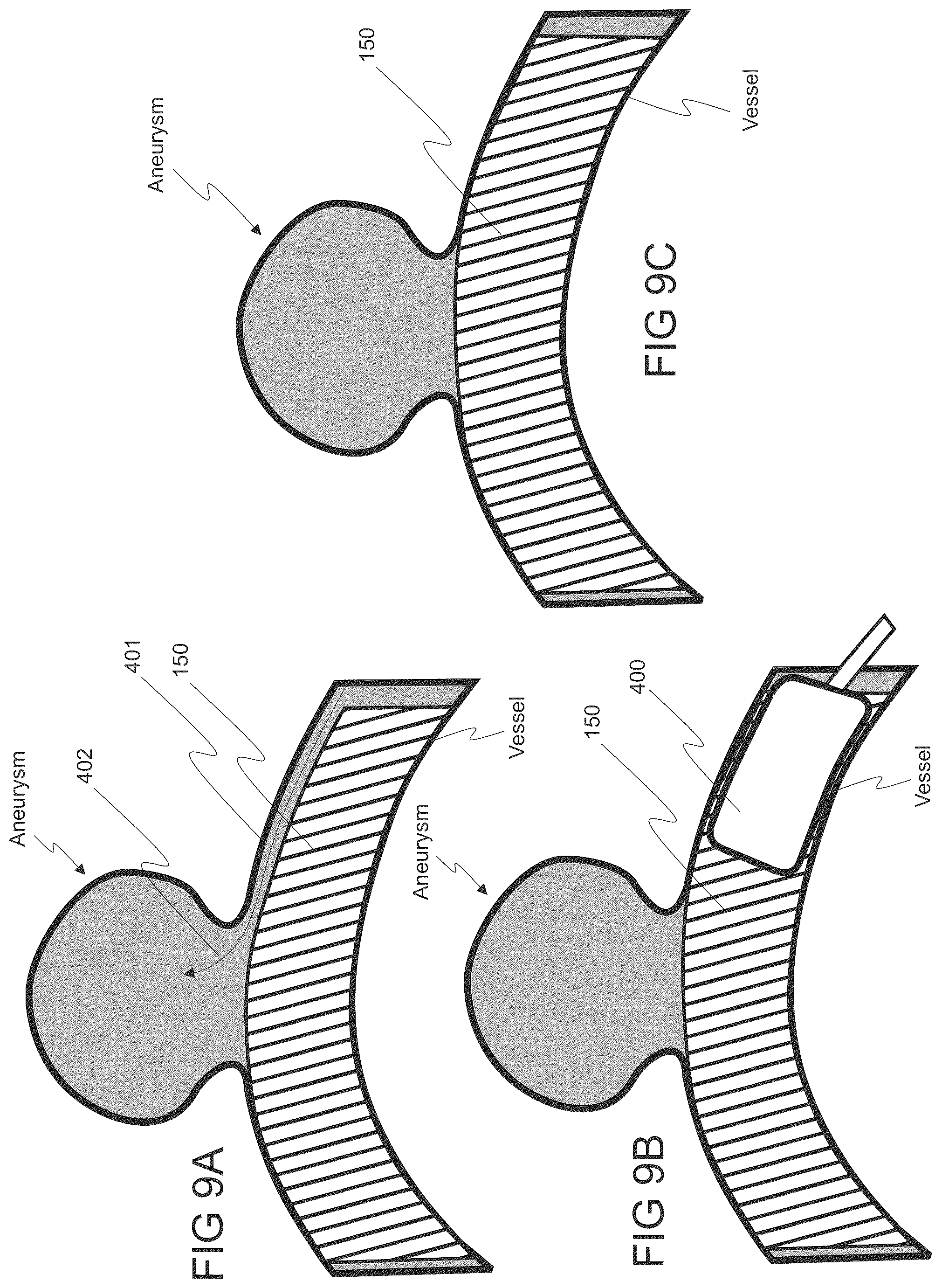 Patent US12564486 Figure 13 – Devices and methods for treating an aneurysm