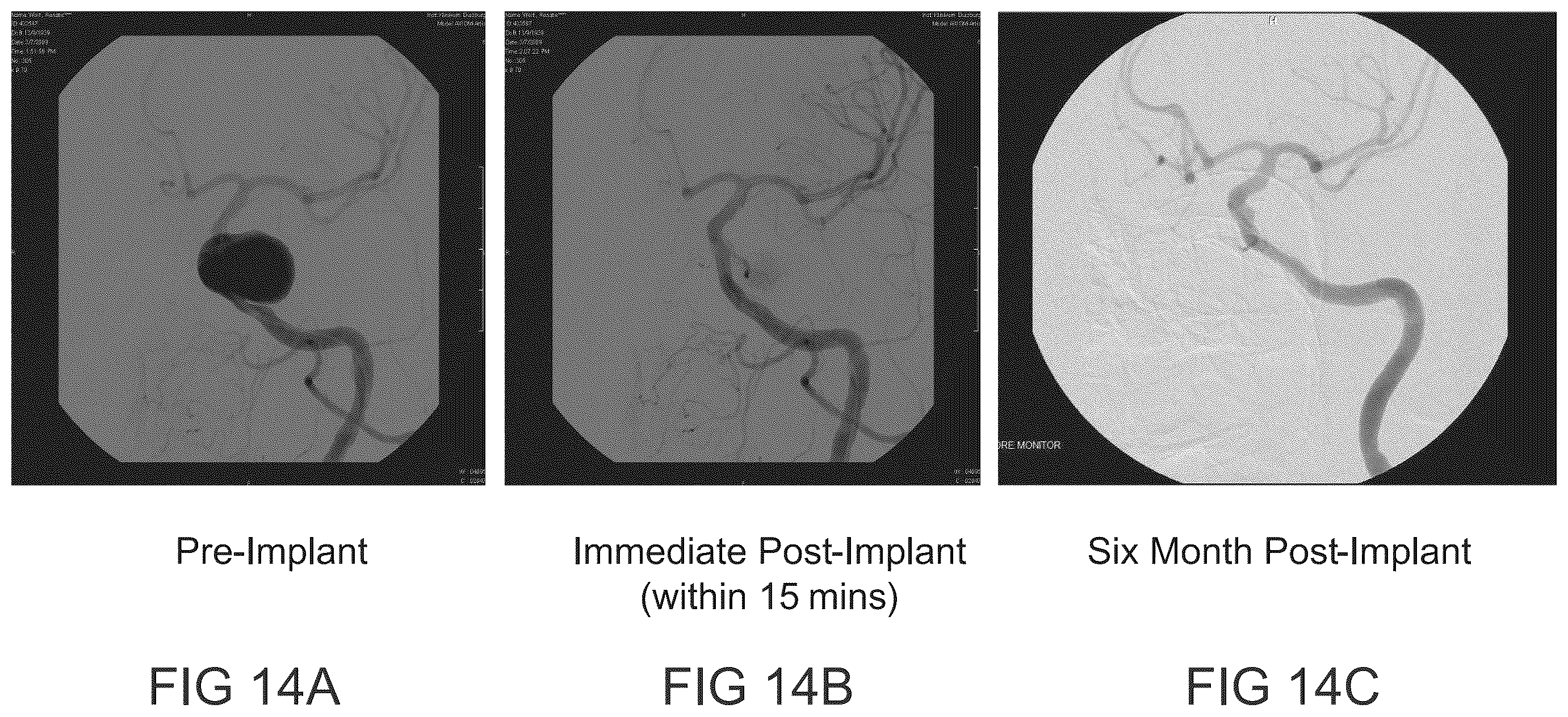 Patent US12564486 Figure 18 – Devices and methods for treating an aneurysm