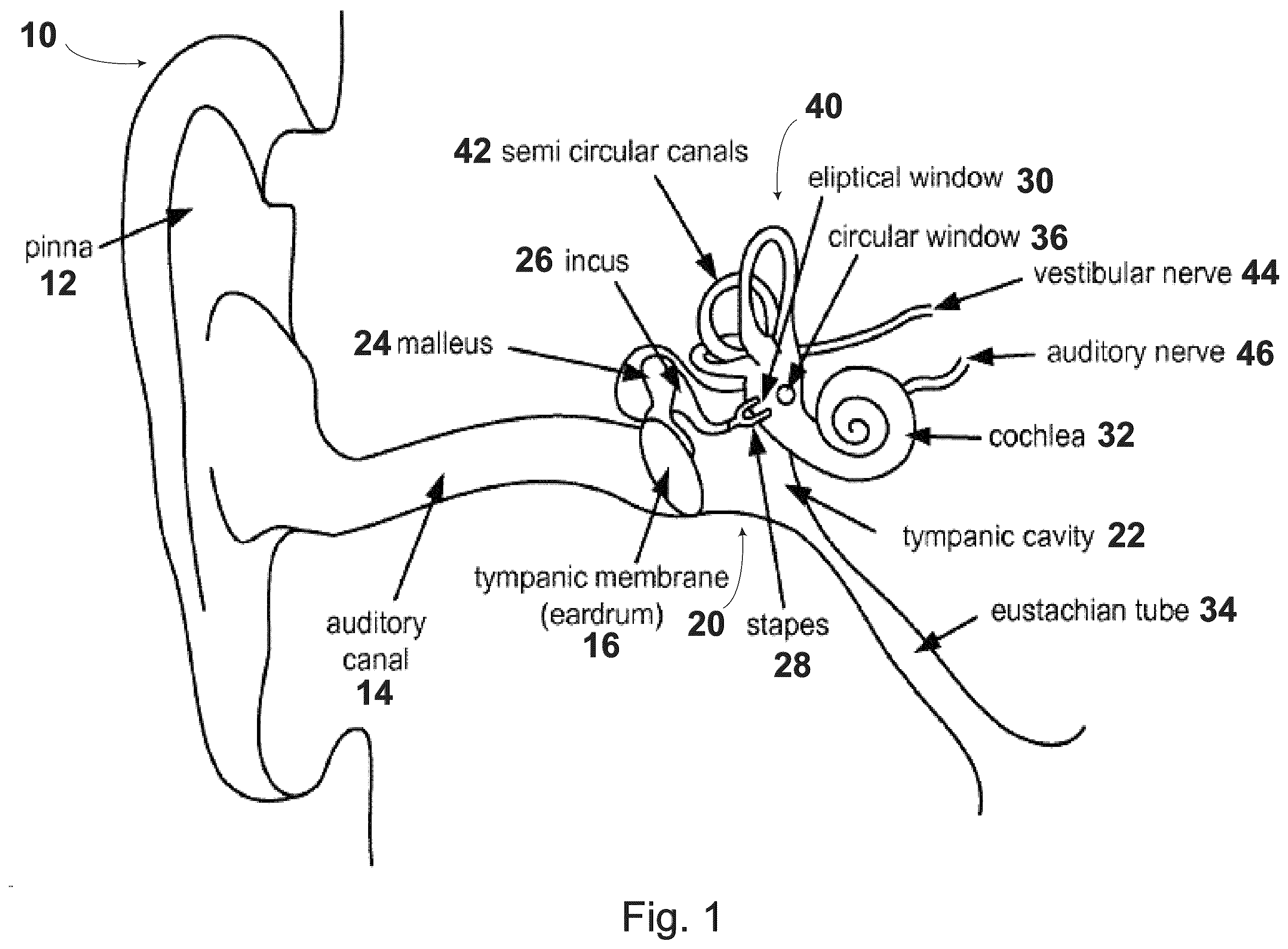 Patent US12564488 Figure 1 – Ossicular replacement prothesis with controllable stapedial conforming function, manufacture method thereof and applicator device therefor