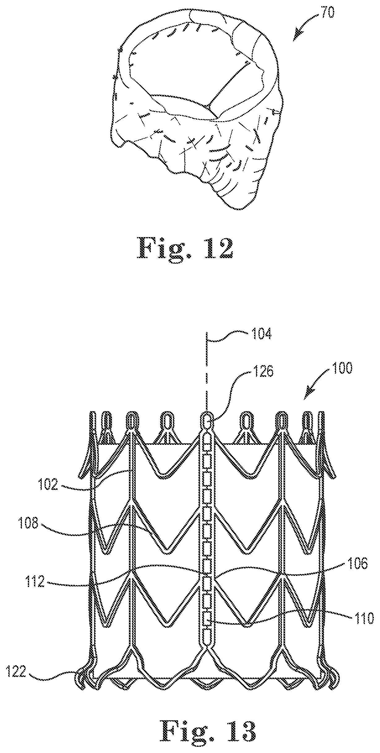 Patent US12564489 Figure 4 – Stented prosthetic heart valves