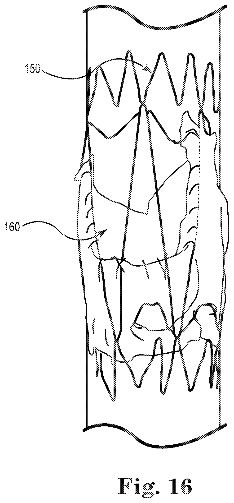 Patent US12564489 Figure 6 – Stented prosthetic heart valves